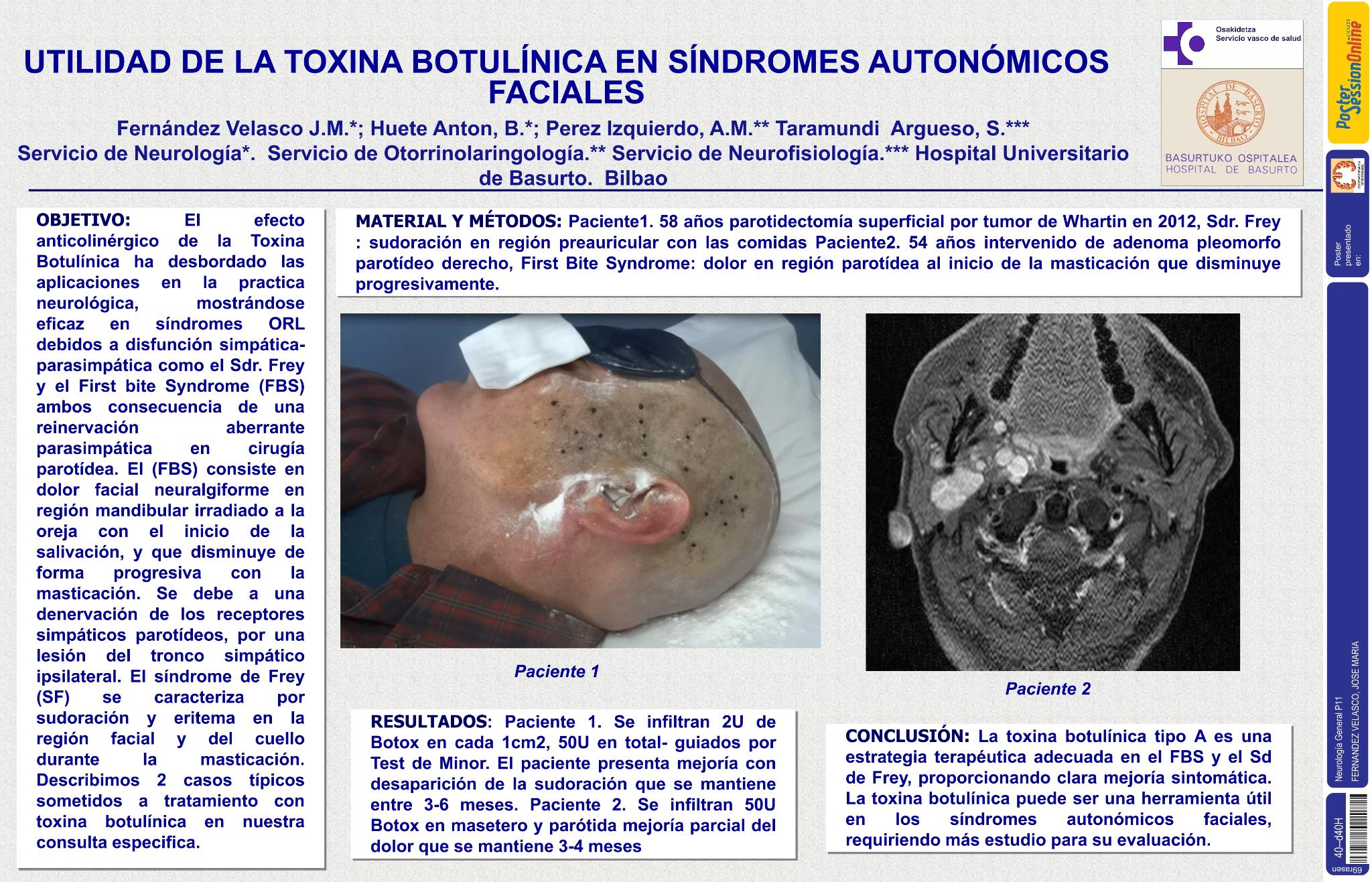 Utilidad de la Toxina Botulínica en síndromes autonómicos faciales