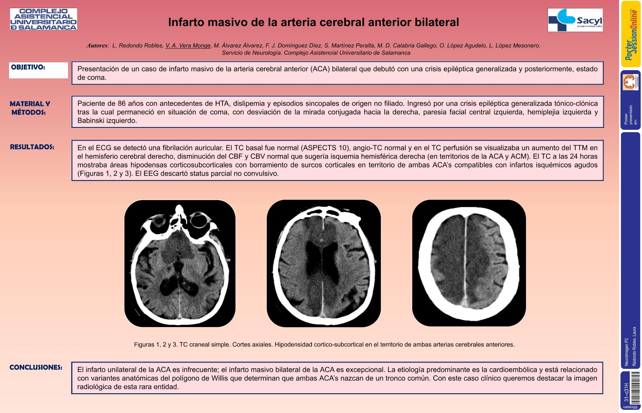 Infarto masivo de la arteria cerebral anterior bilateral