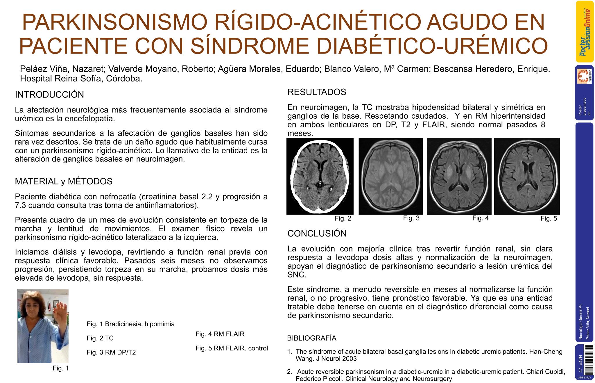 Parkinsonismo rígido-acinético agudo reversible en paciente con síndrome diabético urémico
