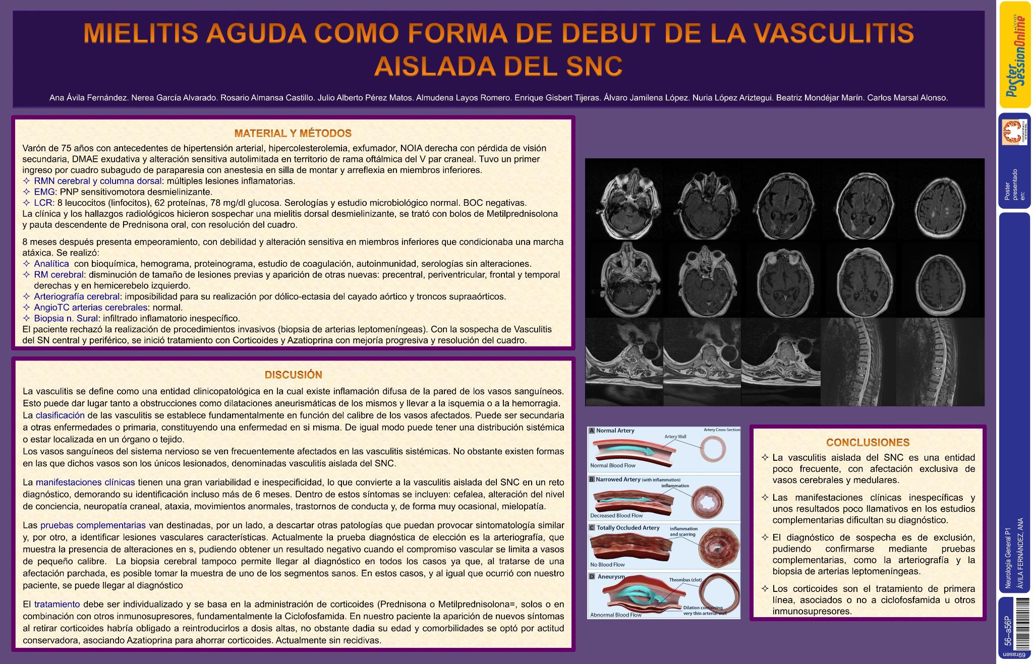 Mielitis subaguda como forma de debut de la vasculitis aislada del Sistema Nervioso (SN)