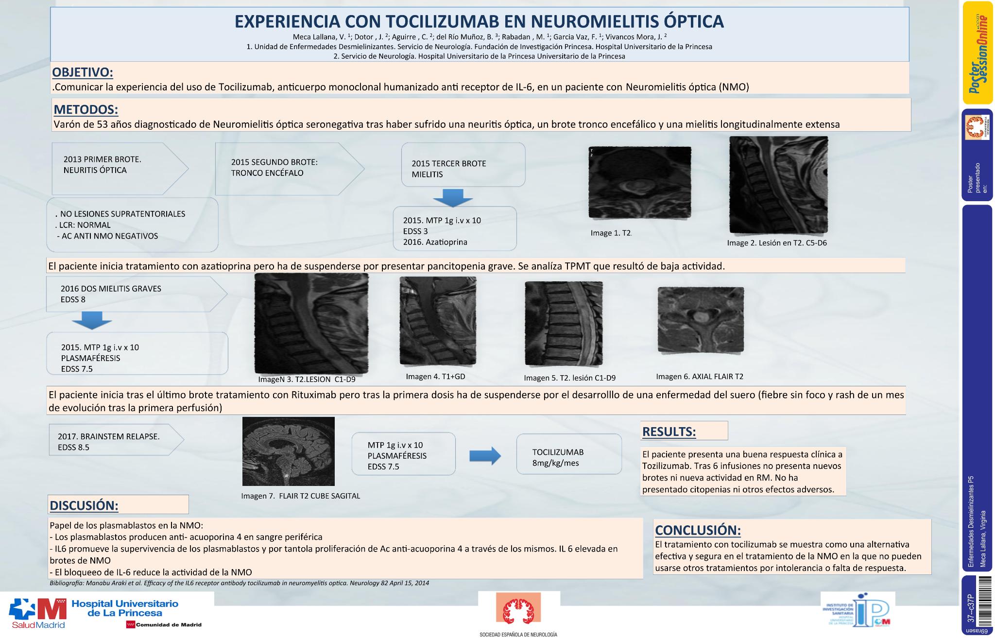 Experiencia con Tocilizumab en el tratamiento de neuromielitis óptica