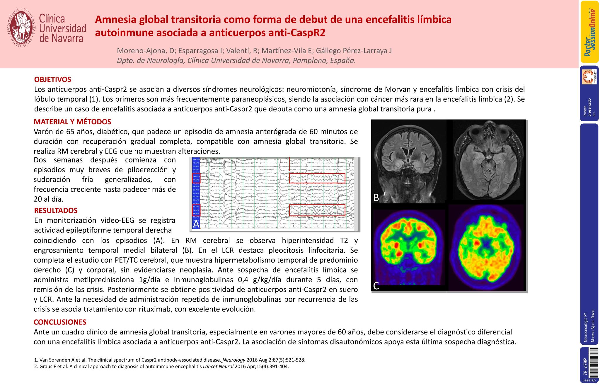 Amnesia global transitoria como forma de debut de una encefalitis límbica autoinmune asociada a anticuerpos anti-Caspr2