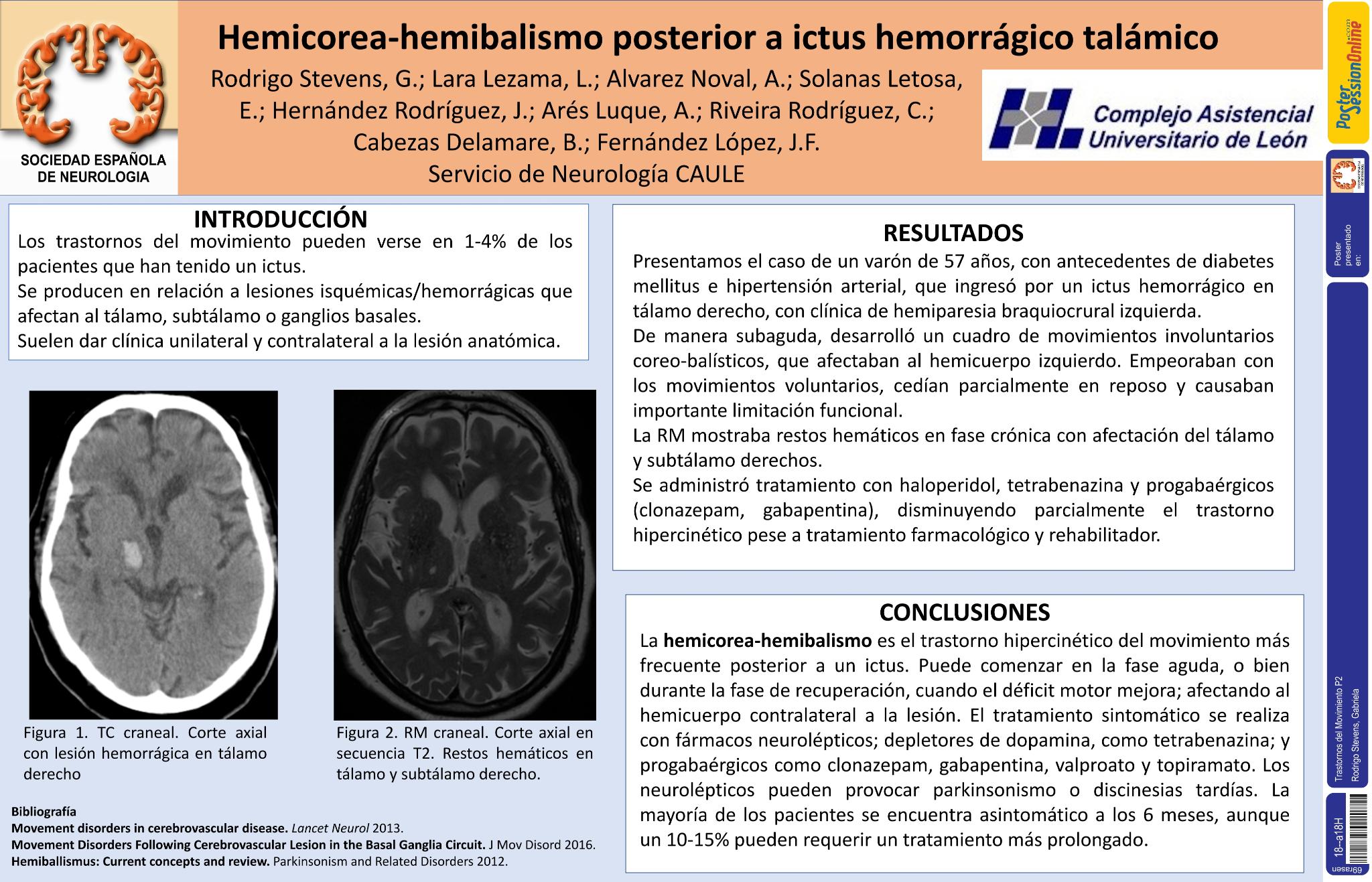 Hemicorea-hemibalismo posterior a ictus hemorrágico talámico