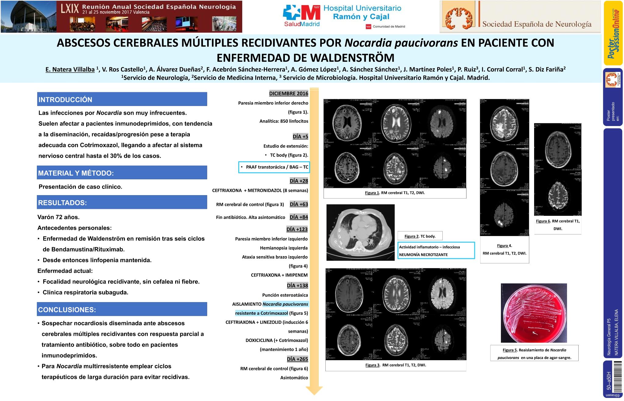 Abscesos cerebrales múltiples recidivantes por Nocardia paucivorans en paciente con enfermedad de Waldeström