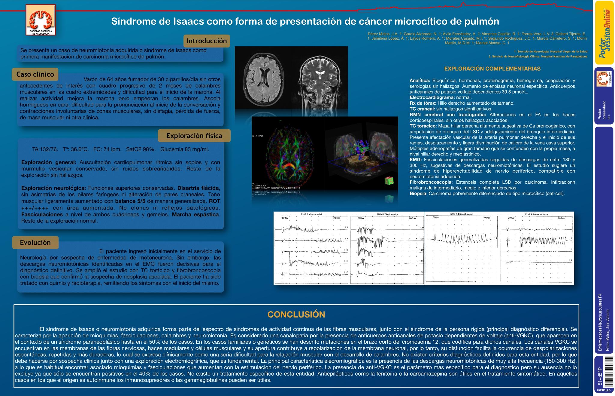 Síndrome de Isaacs como forma de presentación de cáncer microcítico de pulmón