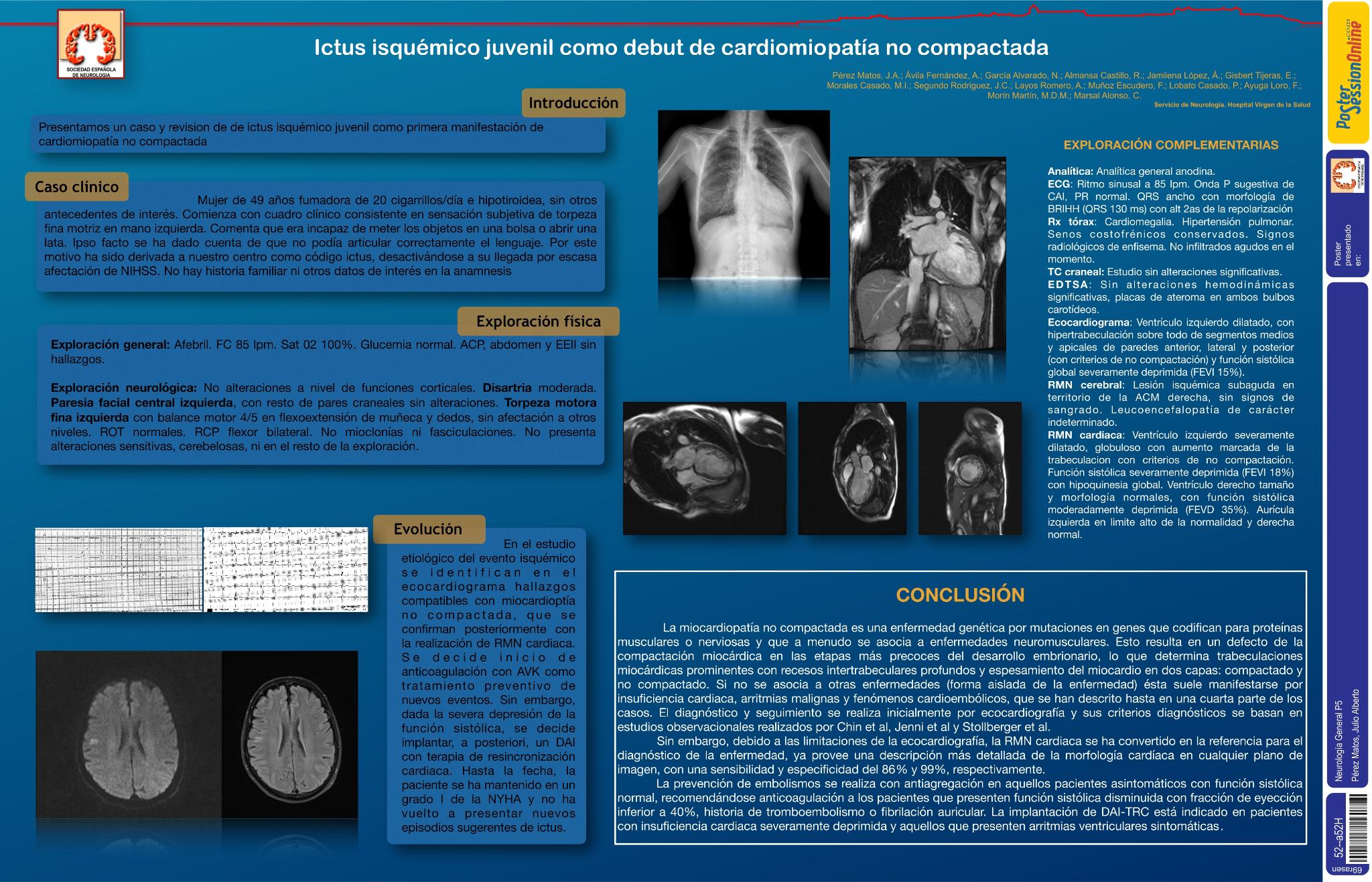 Cardiomiopatía no compactada como causa poco frecuente de ictus juvenil