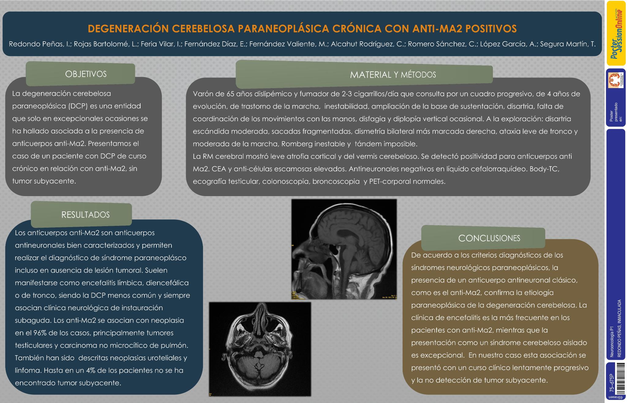 Degeneración cerebelosa paraneoplásica crónica con anti-Ma2 positivos