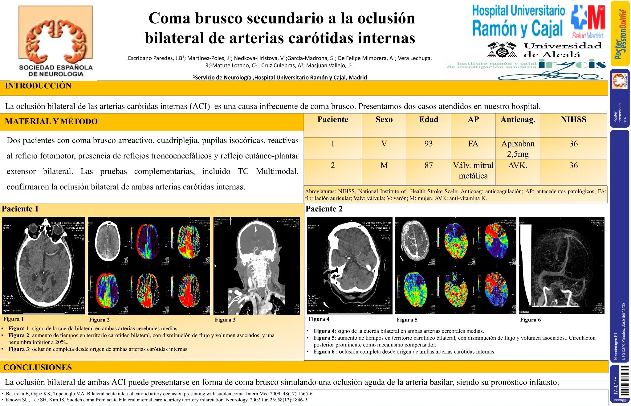 Coma brusco secundario a la oclusión bilateral de arterias carótidas internas
