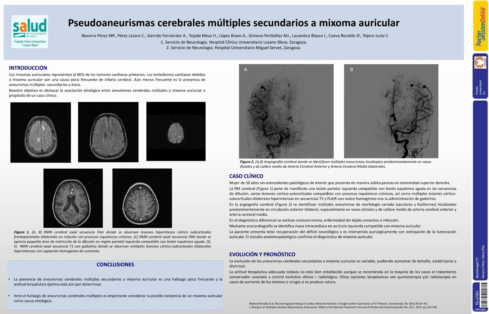Pseudoaneurismas cerebrales múltiples secundarios a mixoma auricular