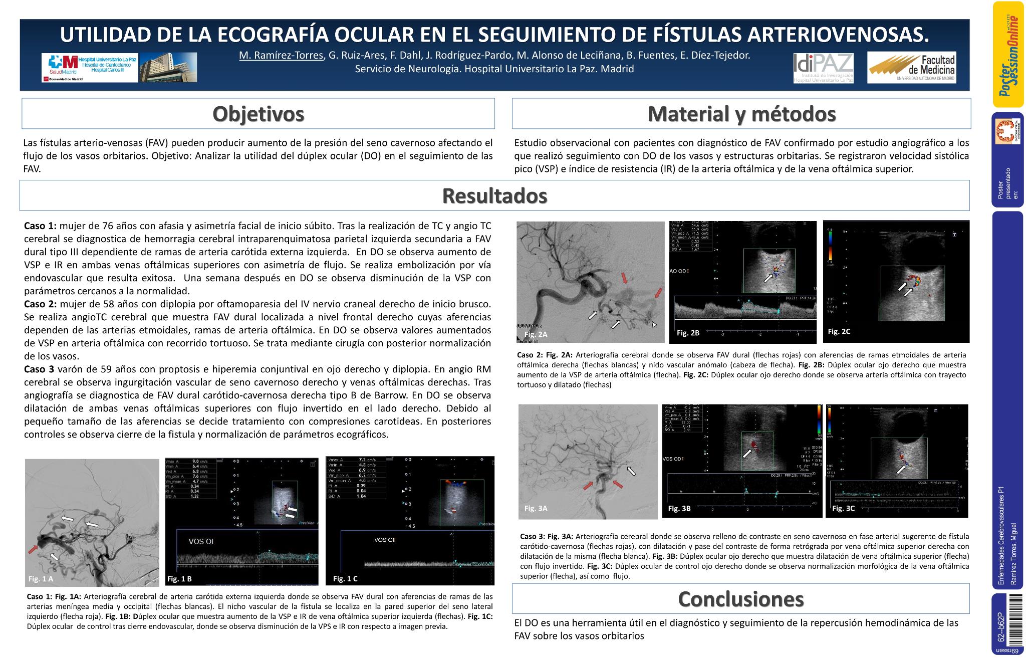 Utilidad de la ecografía ocular en el seguimiento de fístulas arteriovenosas