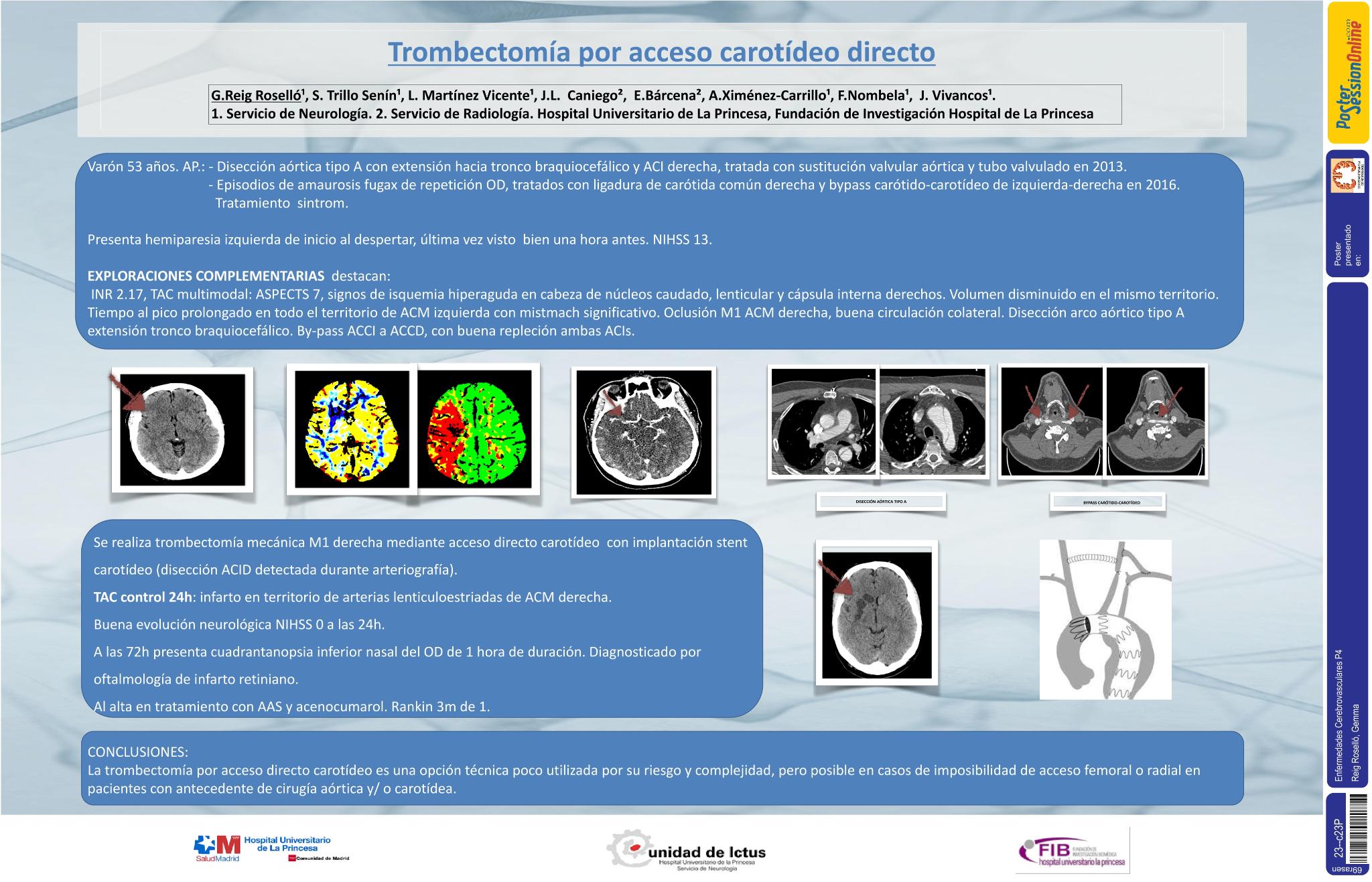 Trombectomía por acceso carotídeo directo