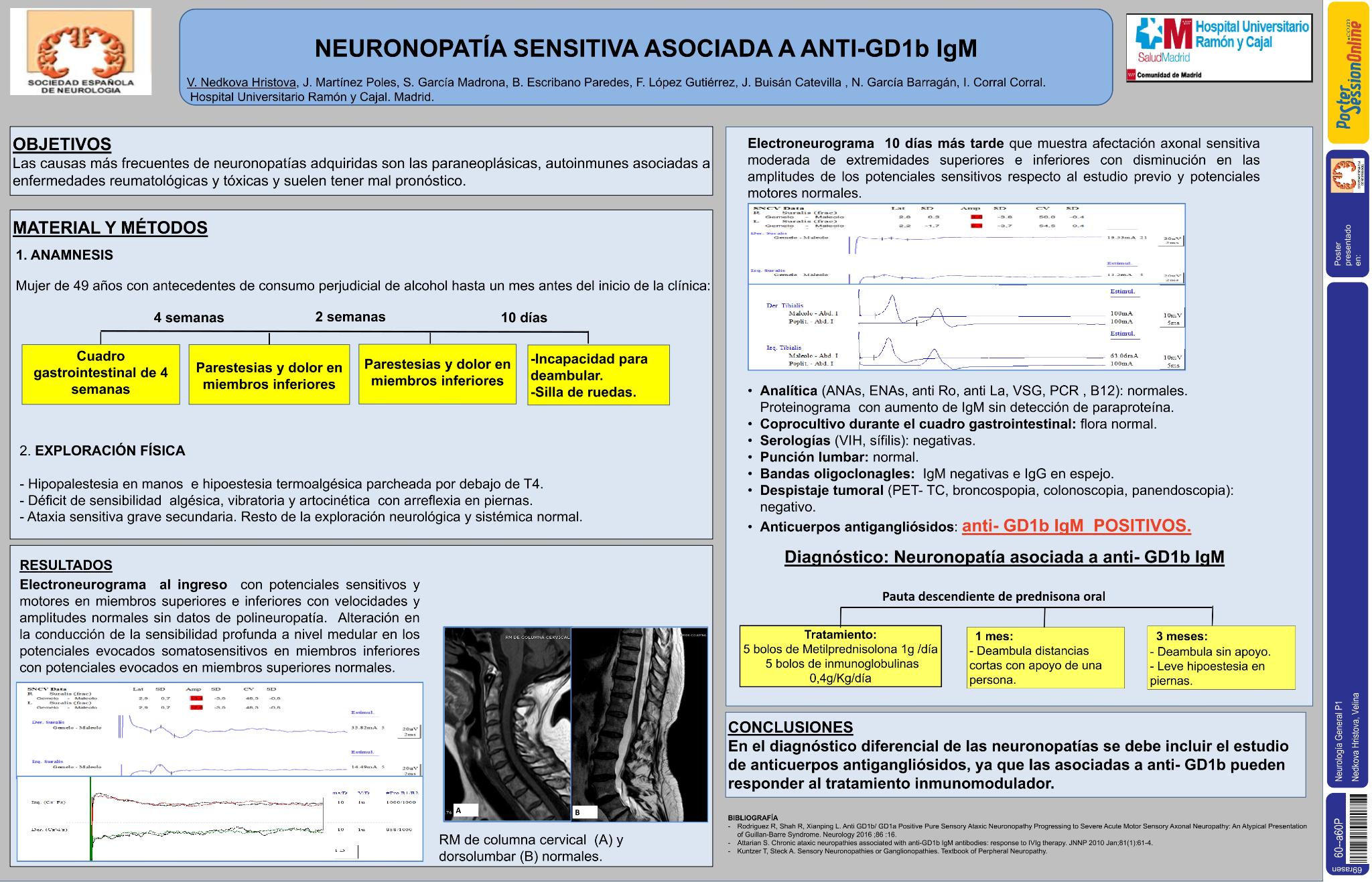 Neuronopatía sensitiva asociada a anti-GD1b IgM