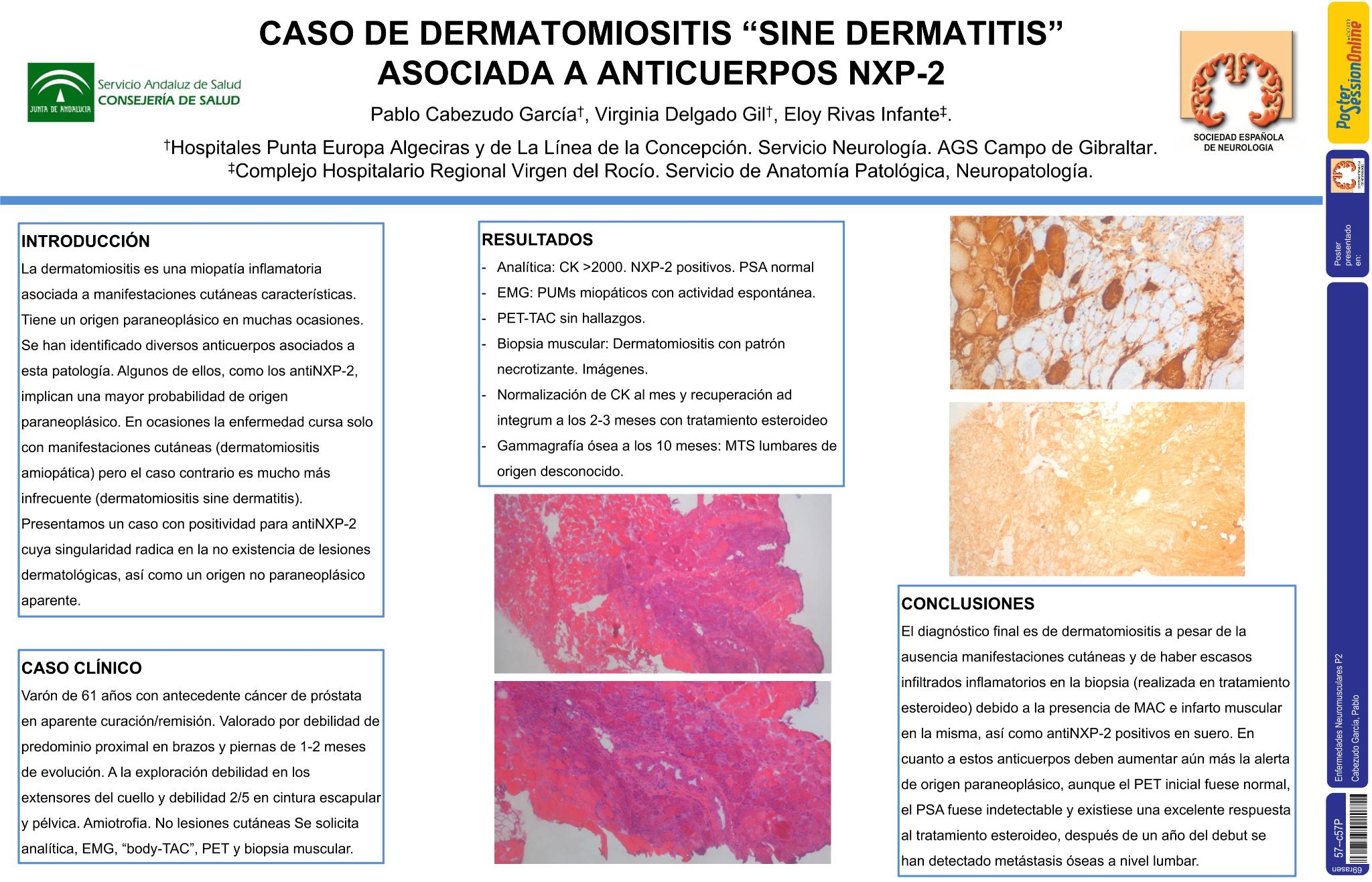 Caso de dermatomiositis “sine dermatitis” asociada a anticuerpos NXP-2 de origen no paraneoplásico