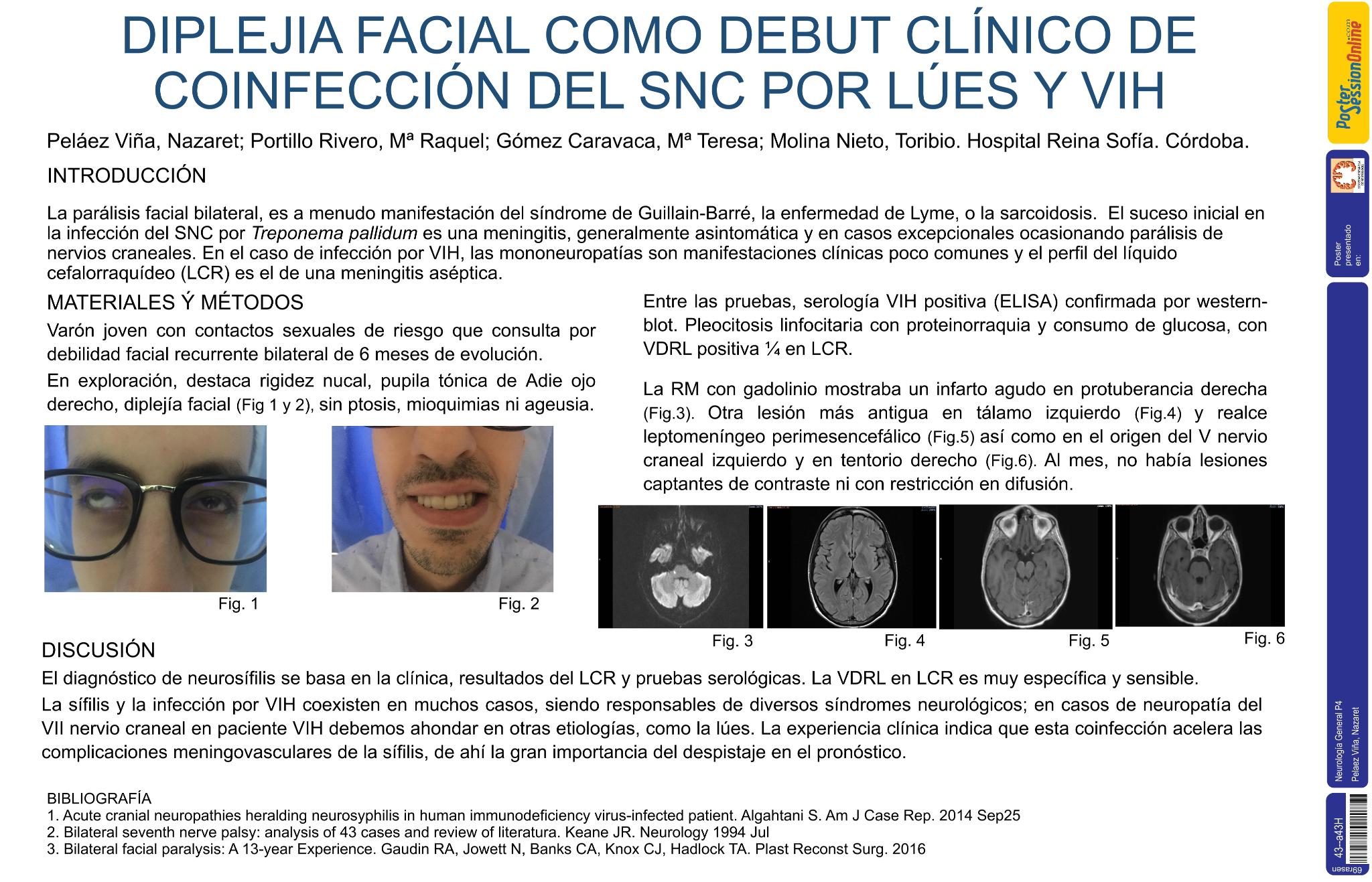 Diplejía facial como debut clínico de coinfección del SNC por lúes y VIH