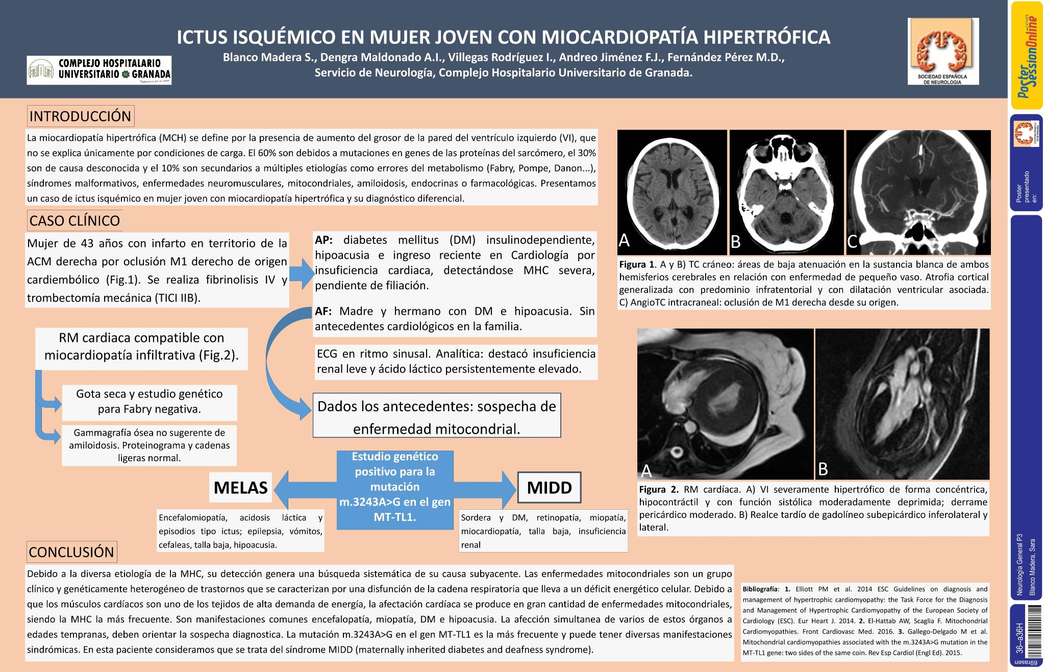 Ictus isquémico en mujer joven con miocardiopatía hipertrófica