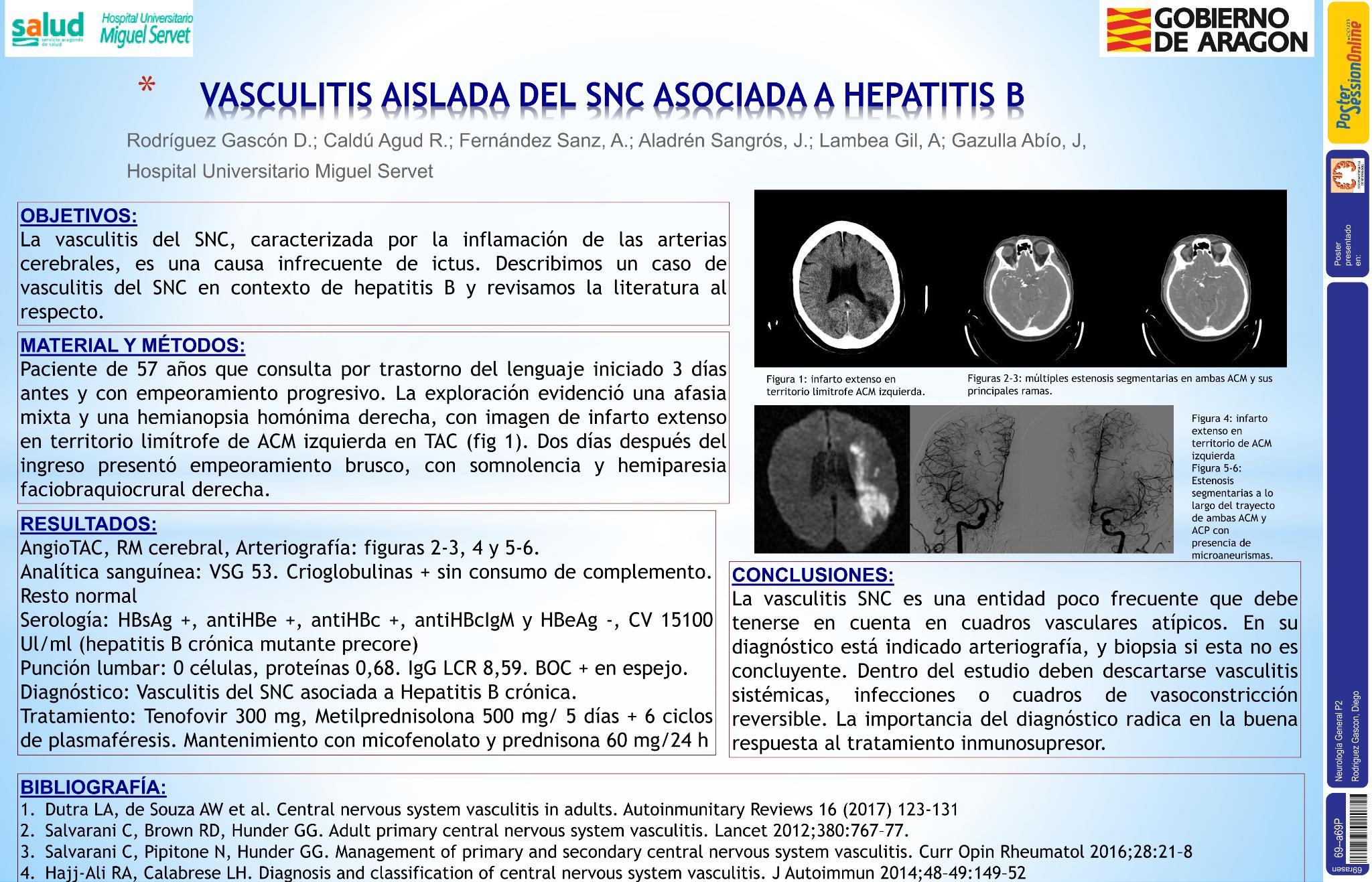 Vasculitis aislada del SNC asociada a Hepatitis B