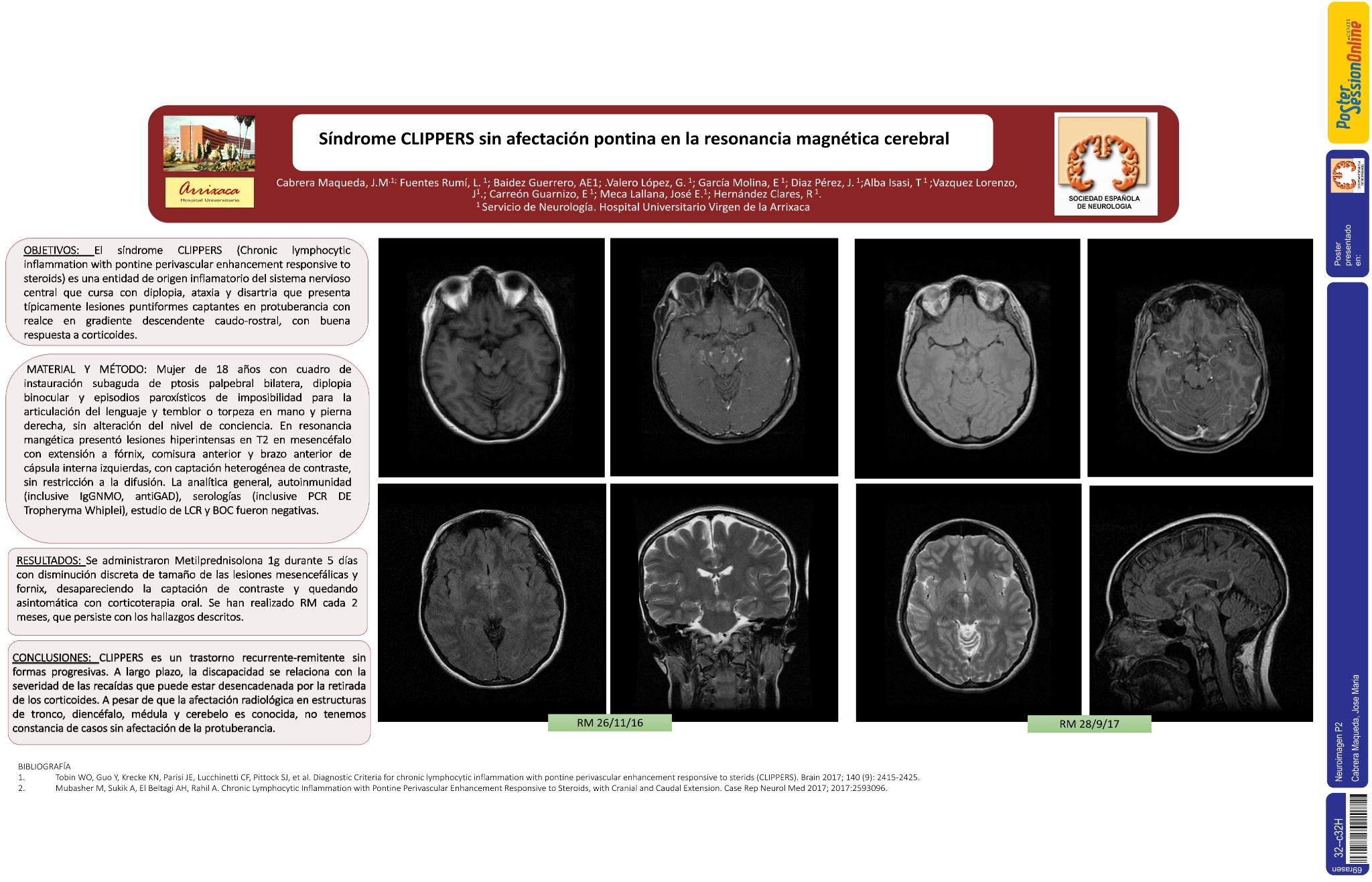 Síndrome CLIPPERS sin afectación pontina en la resonancia magnética cerebral