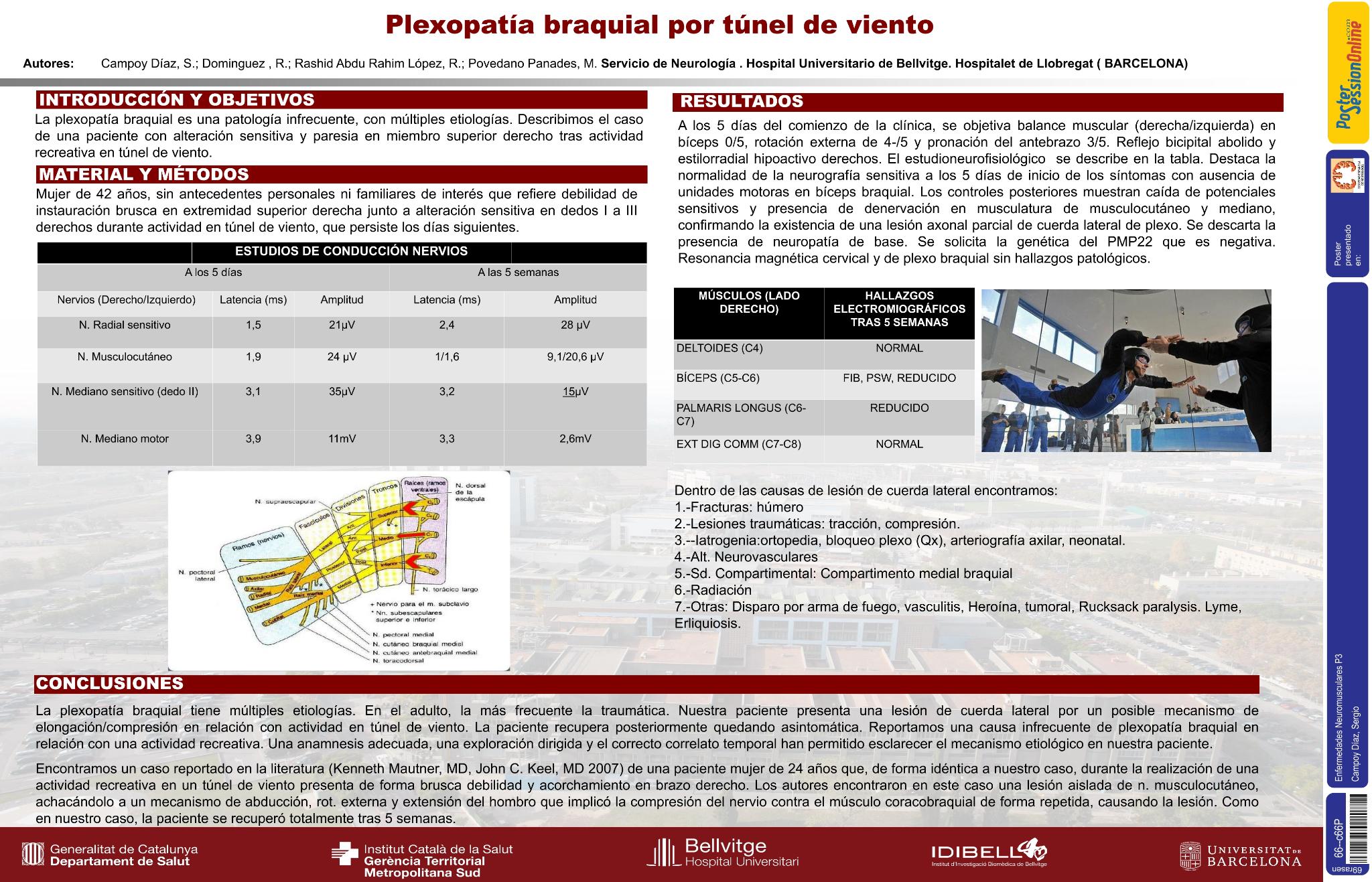 Plexopatía braquial por túnel de viento
