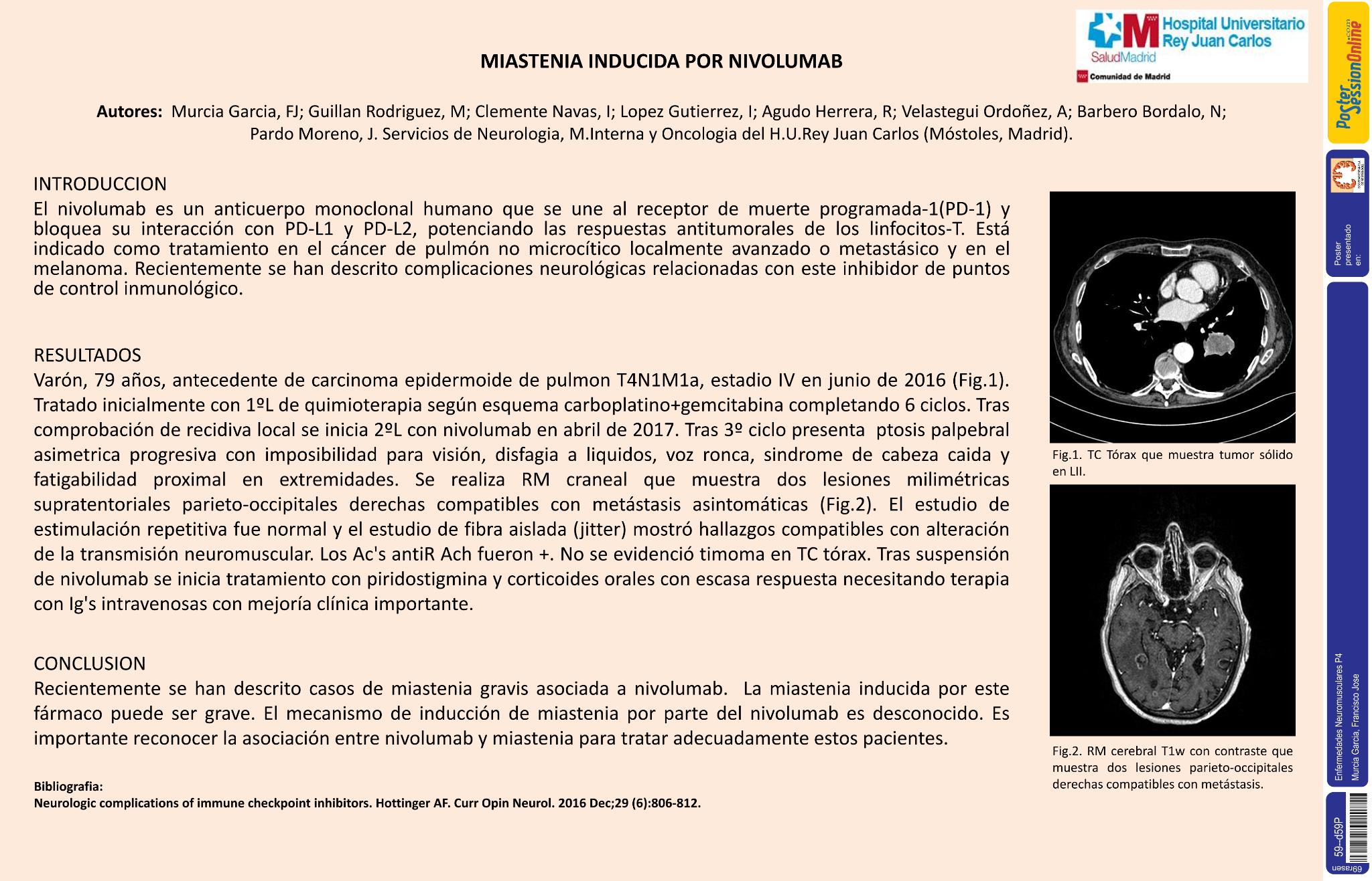 Miastenia inducida por nivolumab