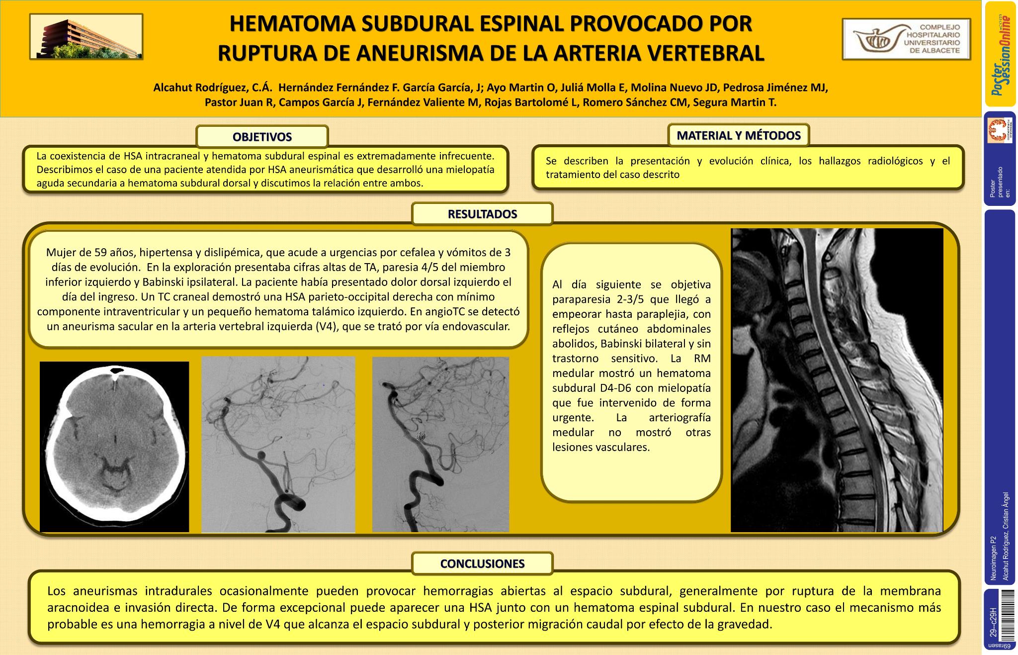 Hematoma subdural espinal provocado por ruptura de aneurisma de la arteria vertebral