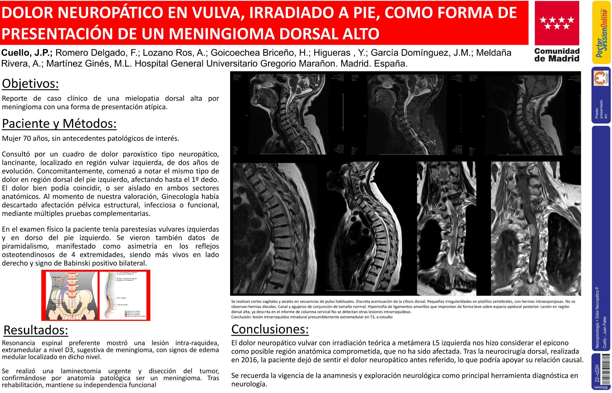 Dolor neuropático en vulva, irradiado a pie, como forma de presentación de un meningioma dorsal alto