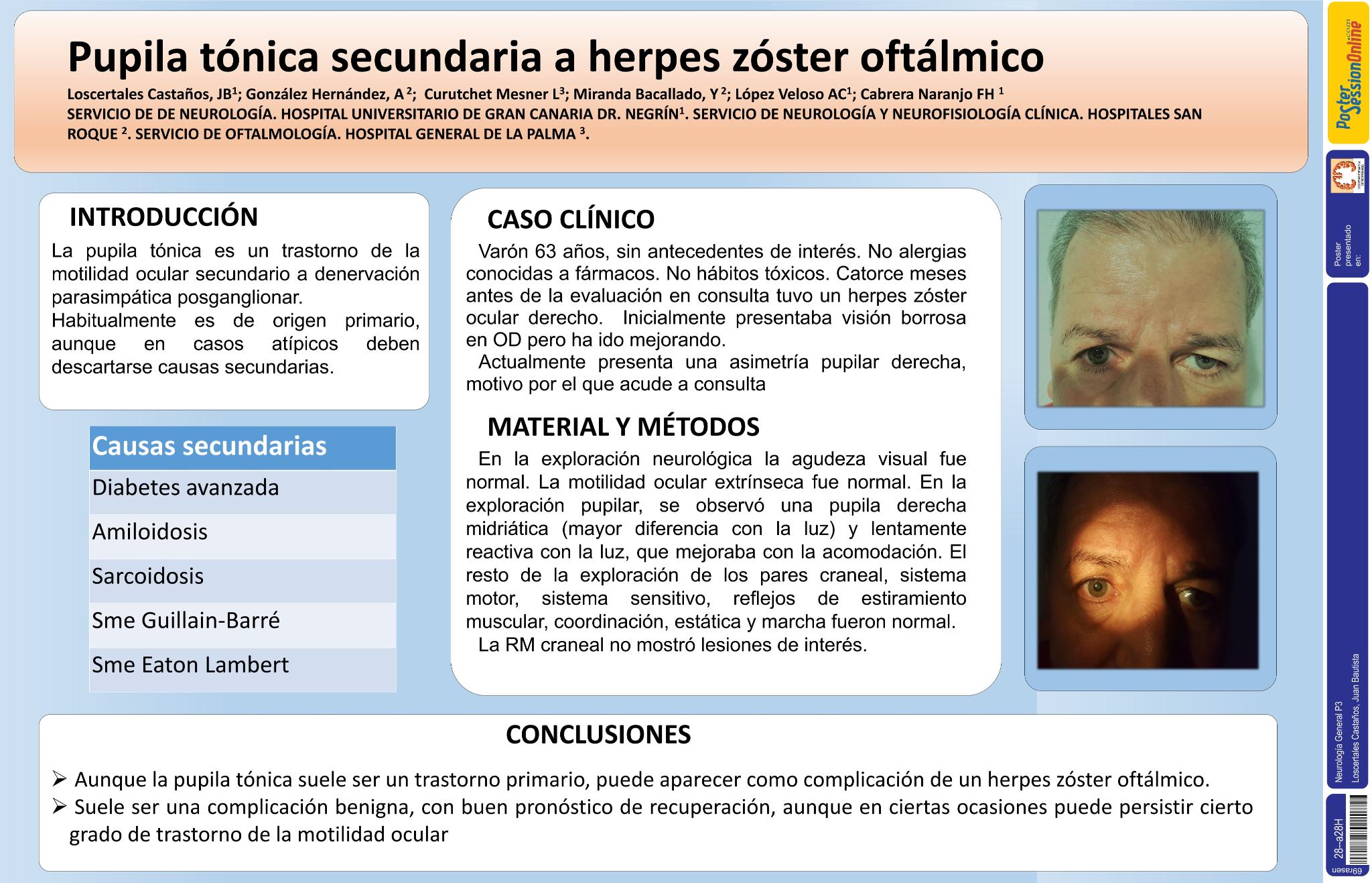 Pupila tónica secundaria a herpes zóster oftálmico