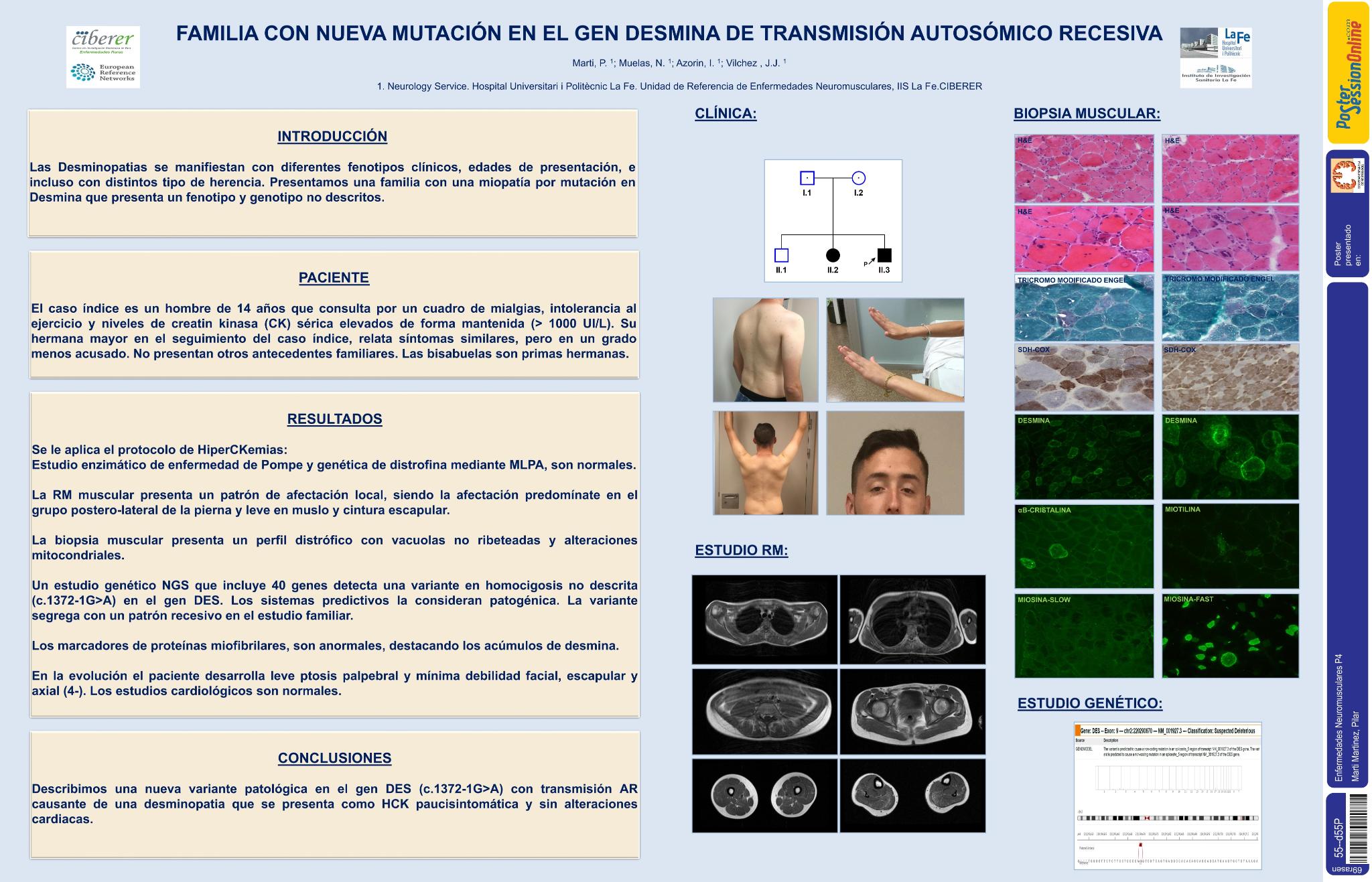 Familia con nueva mutación en el gen DES de transmisión autosómica recesiva