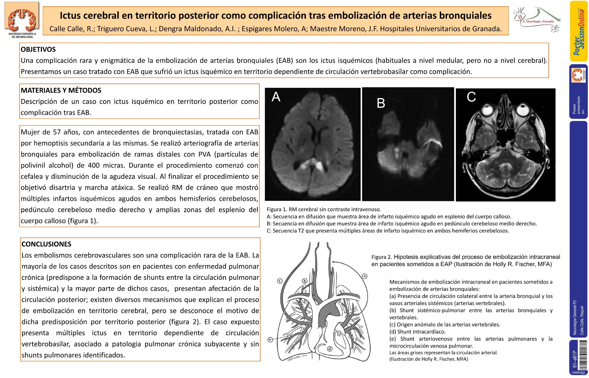 Ictus cerebral en territorio posterior como complicación tras embolización de arterias bronquiales