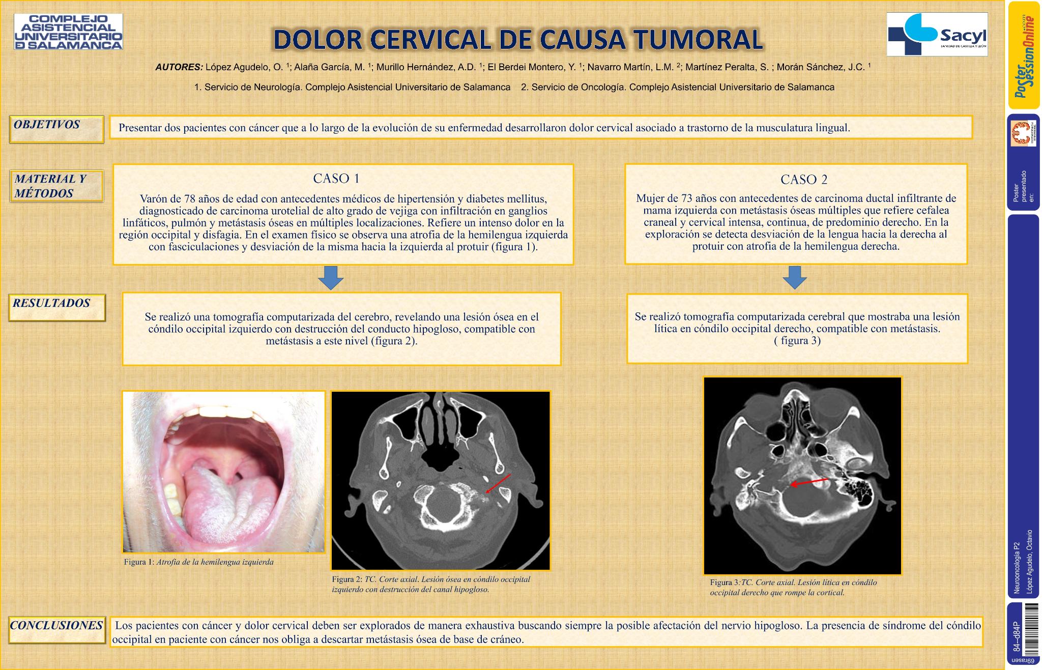 Dolor cervical de causa tumoral