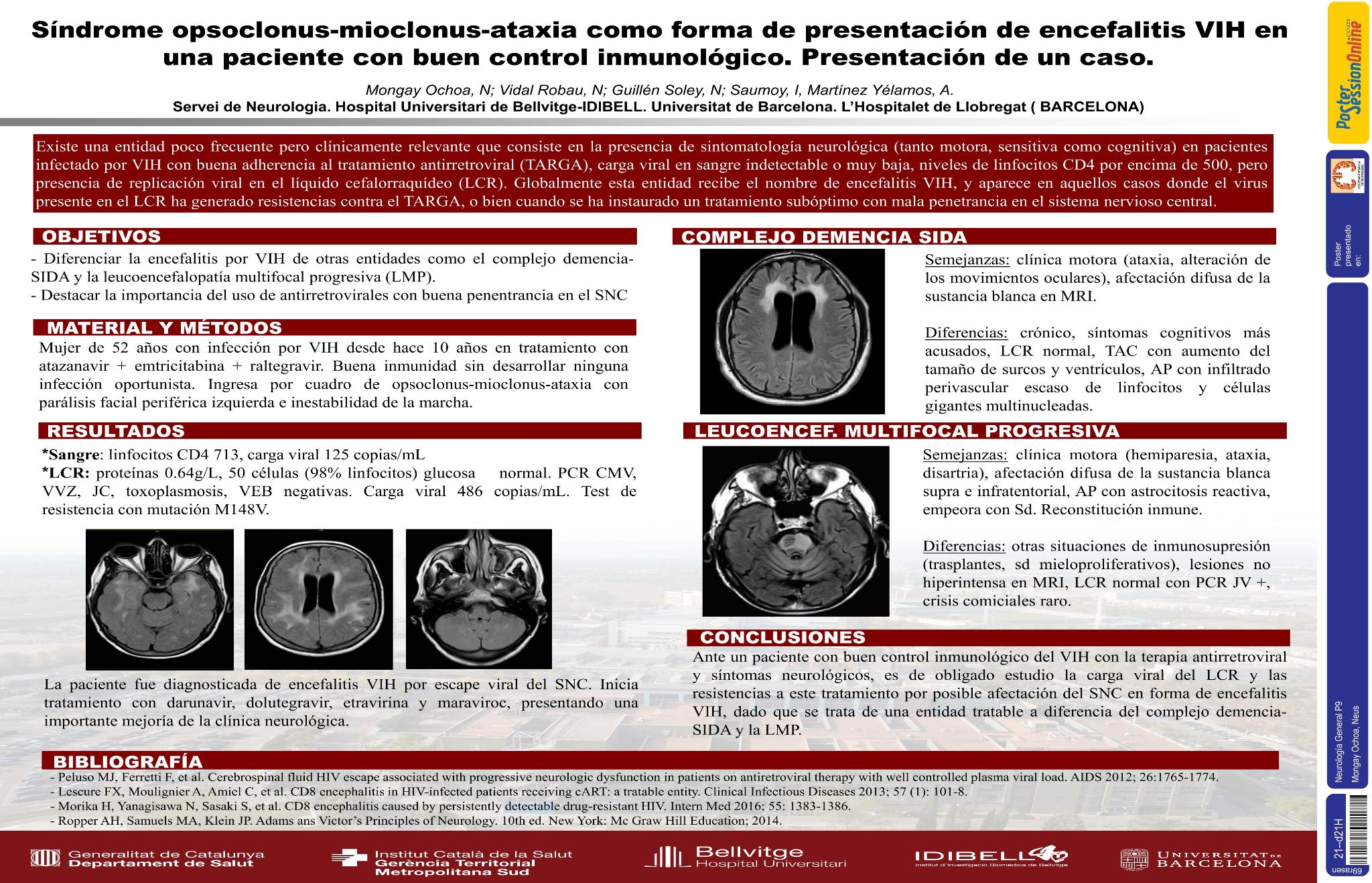 Síndrome opsoclonus-mioclonus-ataxia como forma de presentación de encefalitis por VIH en una paciente con buen control inmunológico. Presentación de un caso