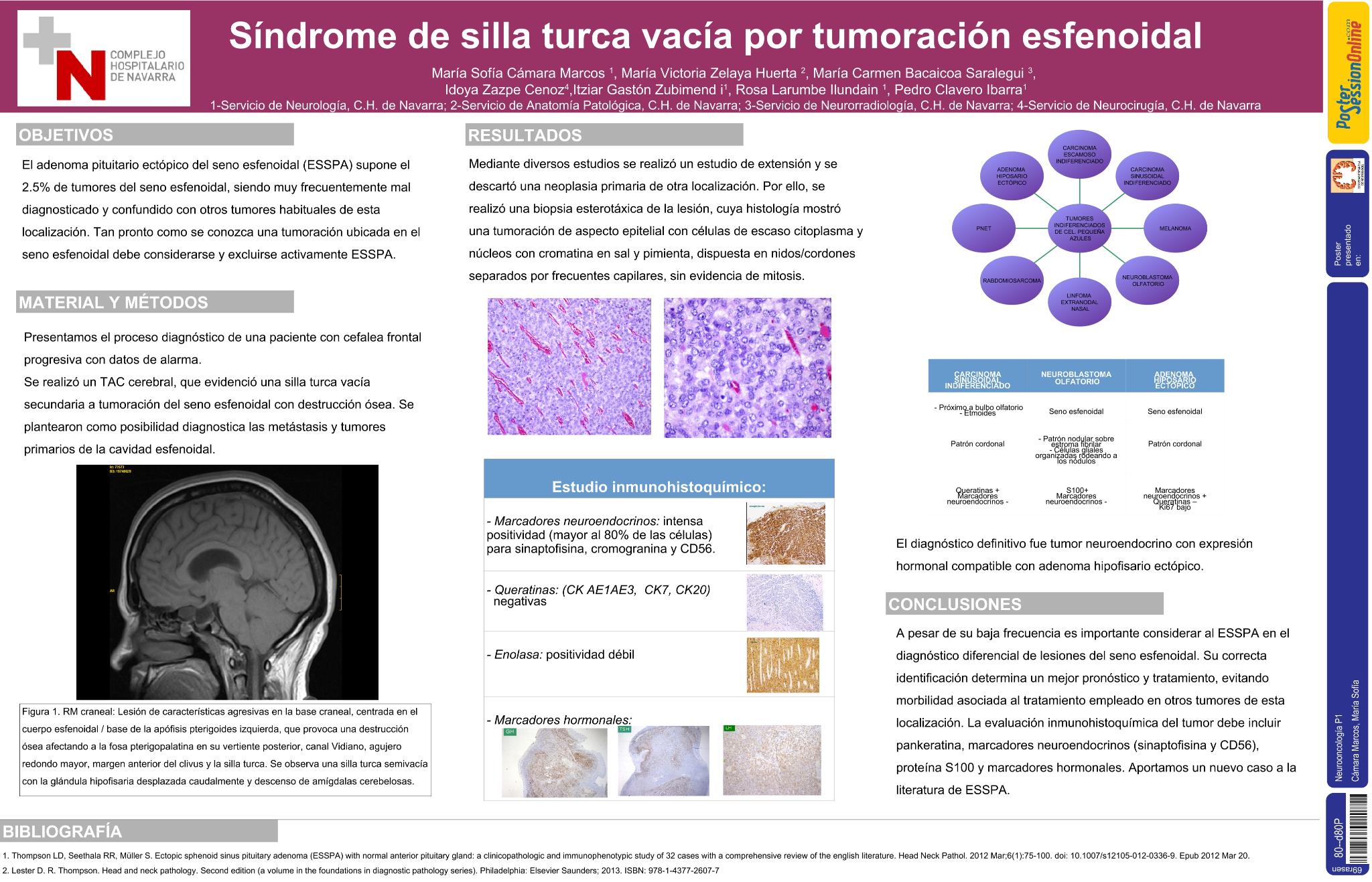 Síndrome de silla turca vacía por tumoración esfenoidal