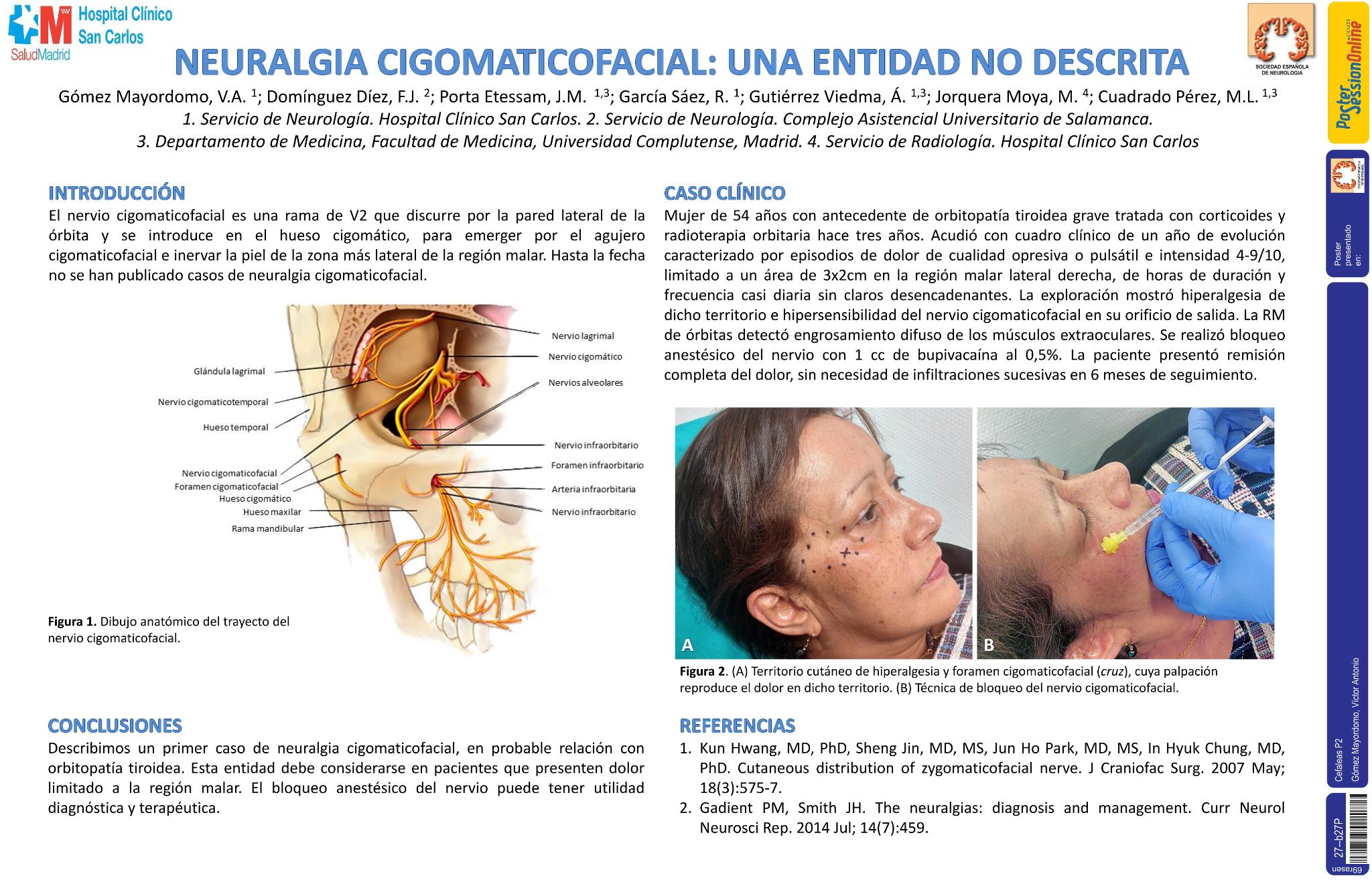 Neuralgia cigomaticofacial: una entidad no descrita