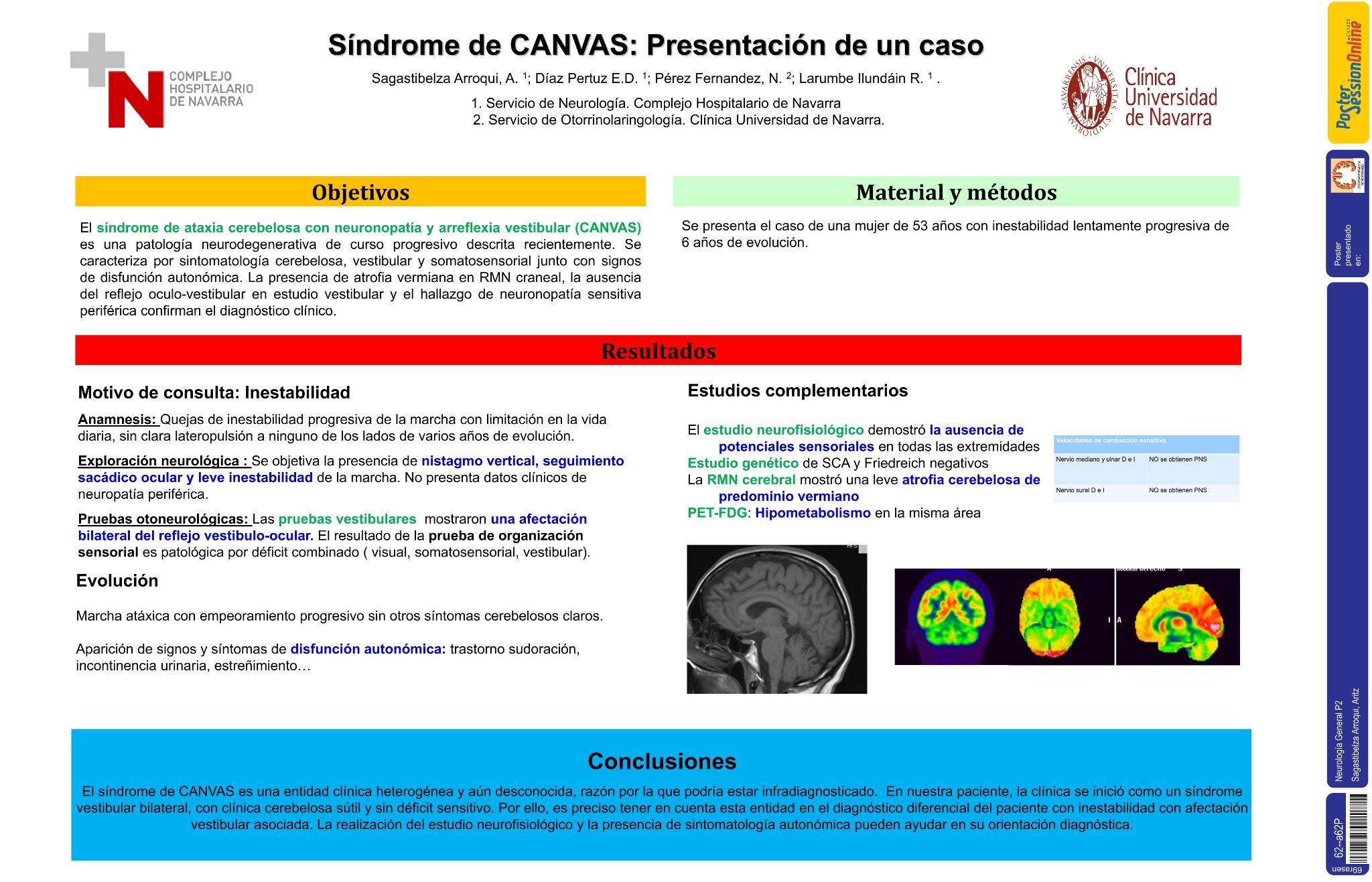 Síndrome de CANVAS: presentación de un caso