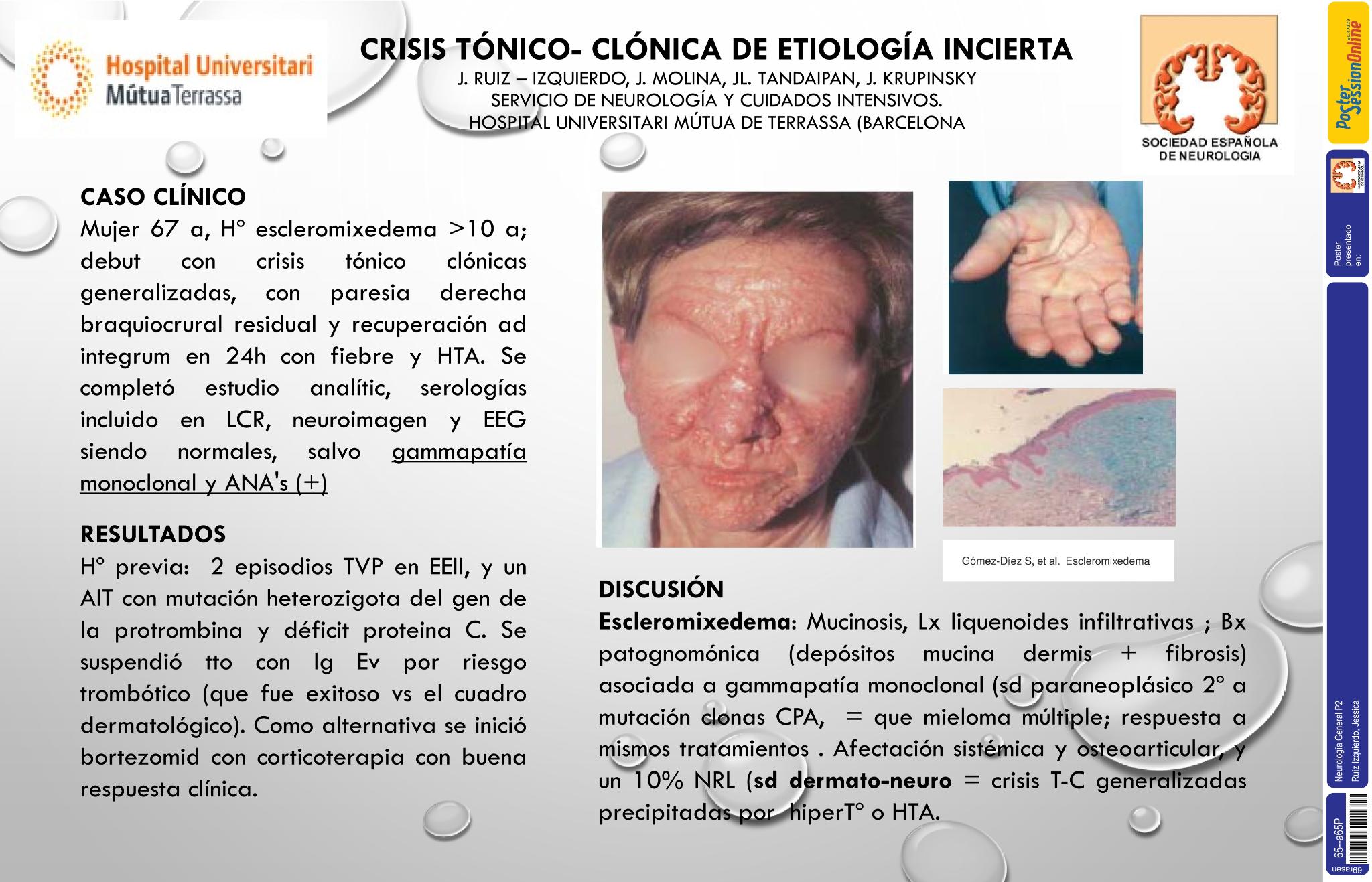 Crisis tónico clónicas de etiología incierta