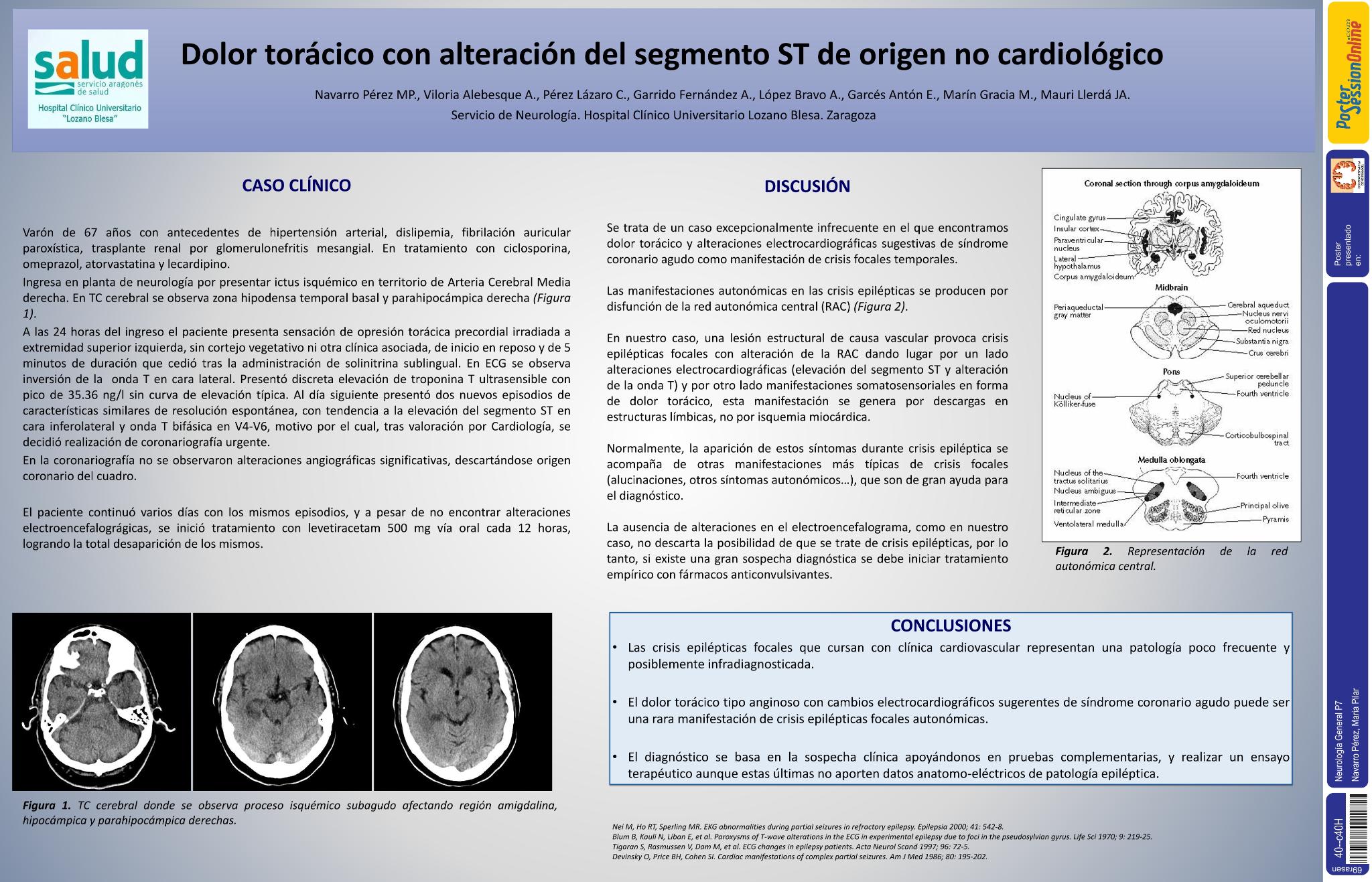 Dolor torácico con alteración del segmento ST de origen no cardiológico