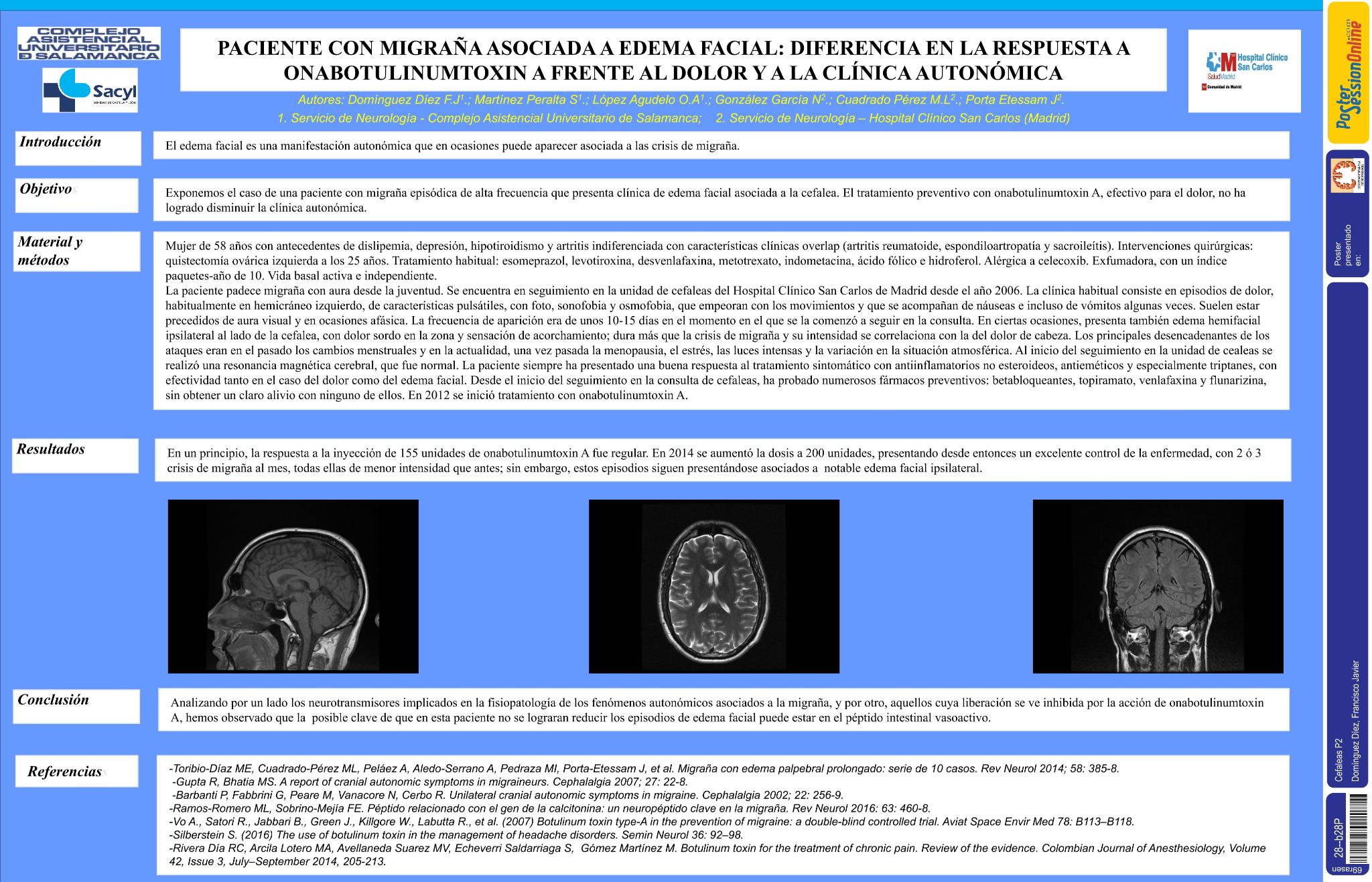 Migraña asociada a edema facial: diferencia en la respuesta a onabotulinumtoxin A frente al dolor y a la clínica autonómica