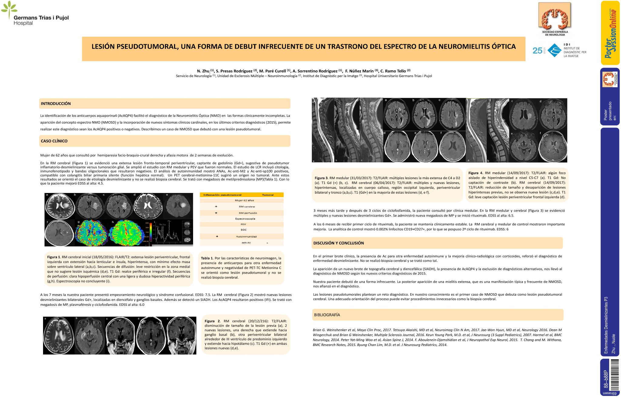 Lesión pseudotumoral, una forma de debut infrecuente de un trastorno del espectro de la neuromielitis óptica