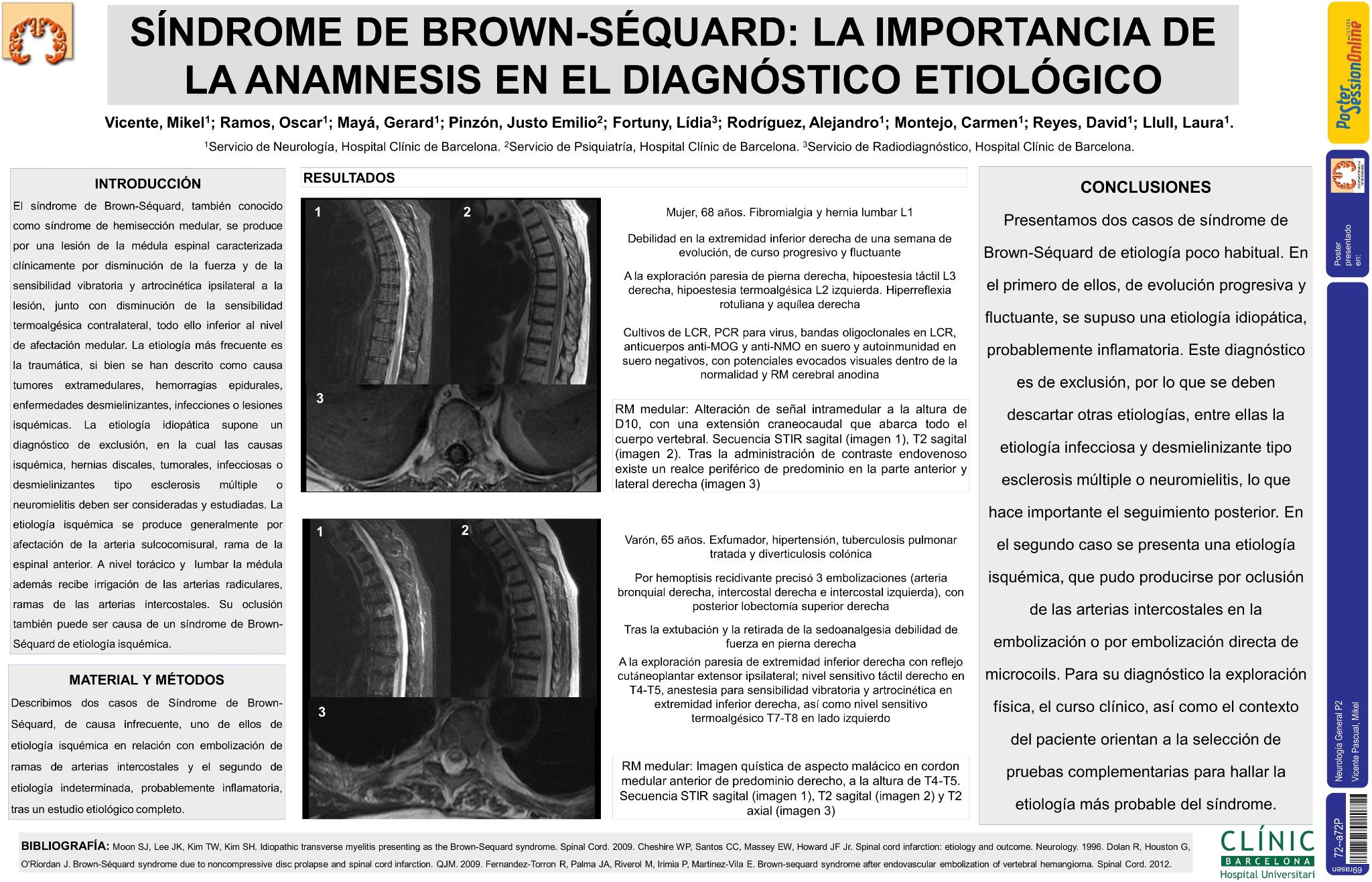 Síndrome de Brown-Séquard: la importancia de la anamnesis en el diagnóstico etiológico