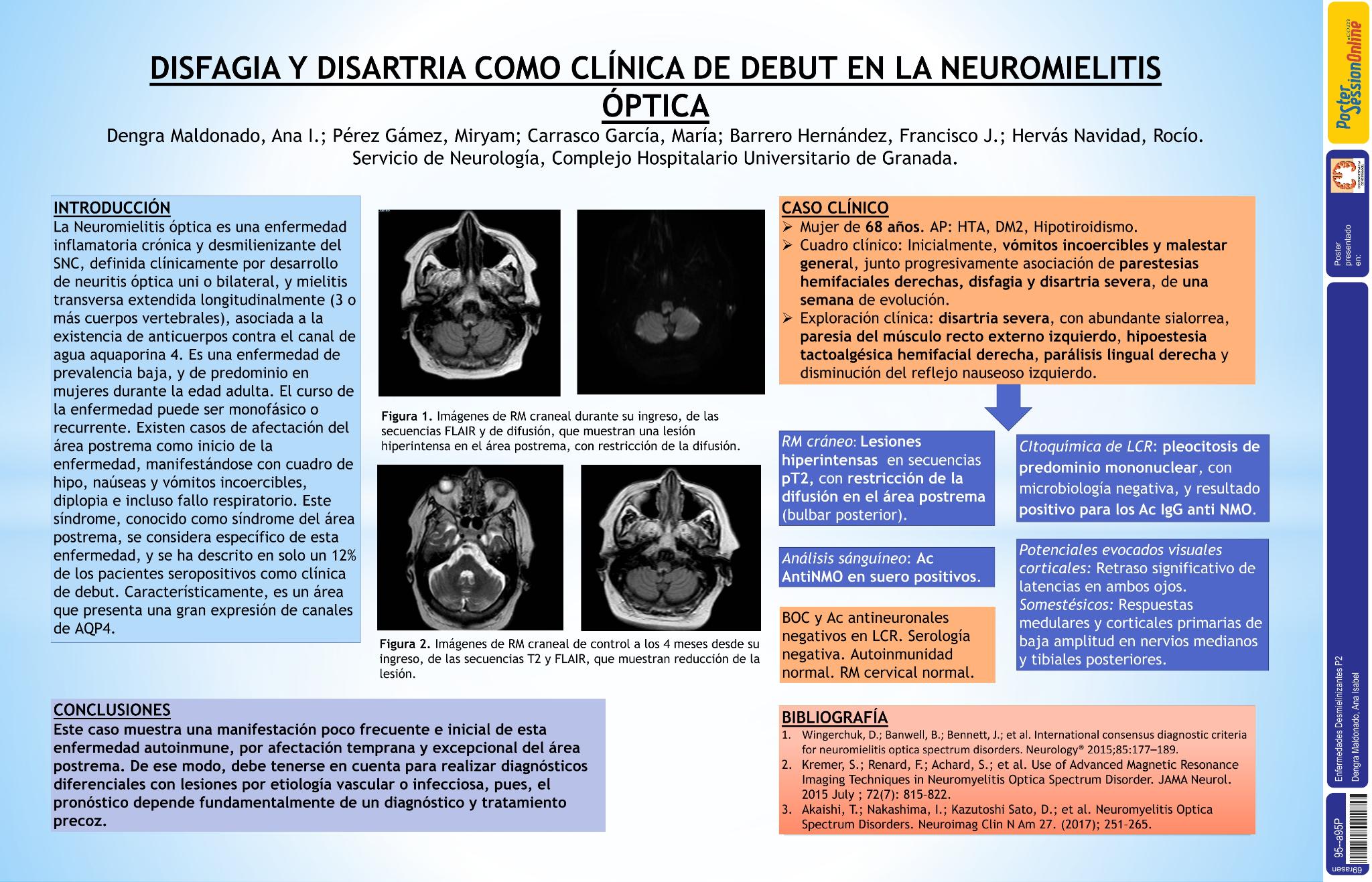 Disfagia y disartria como clínica de debut en la neuromielitis óptica