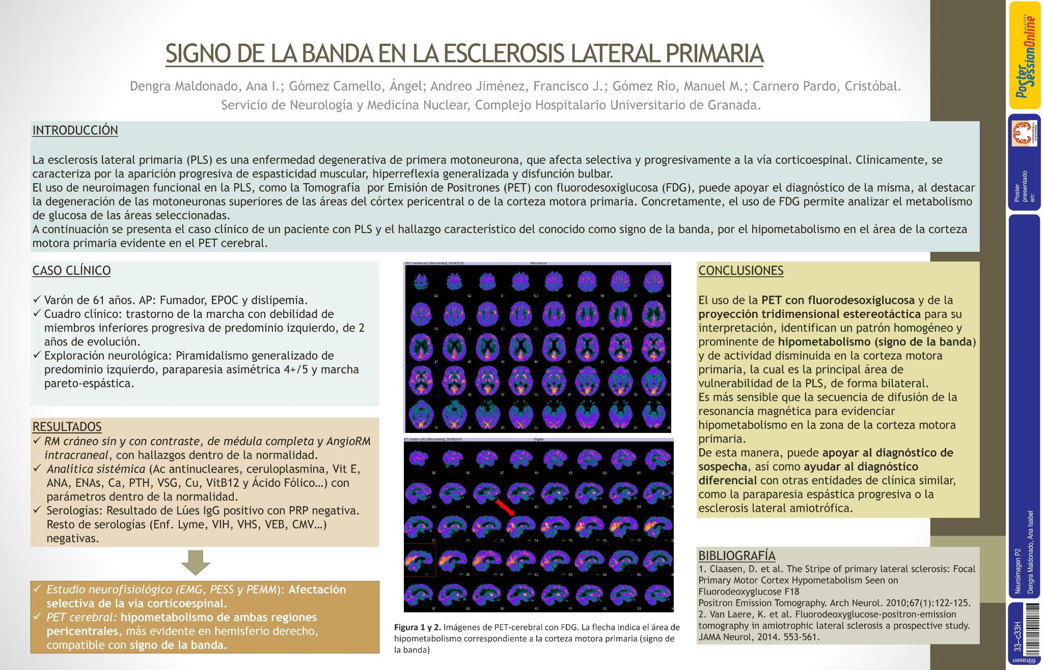 Signo de la banda en la Esclerosis Lateral Primaria