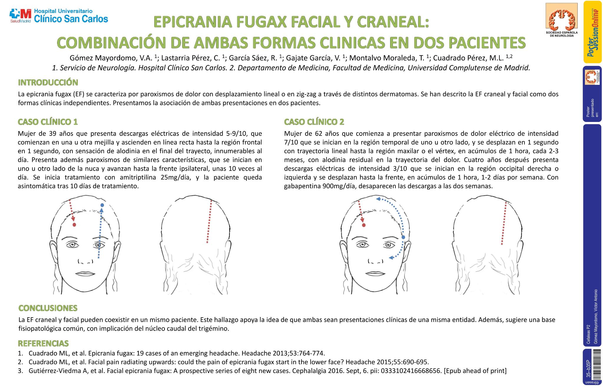 Epicrania fugax facial y craneal: combinación de ambas formas clínicas en dos pacientes