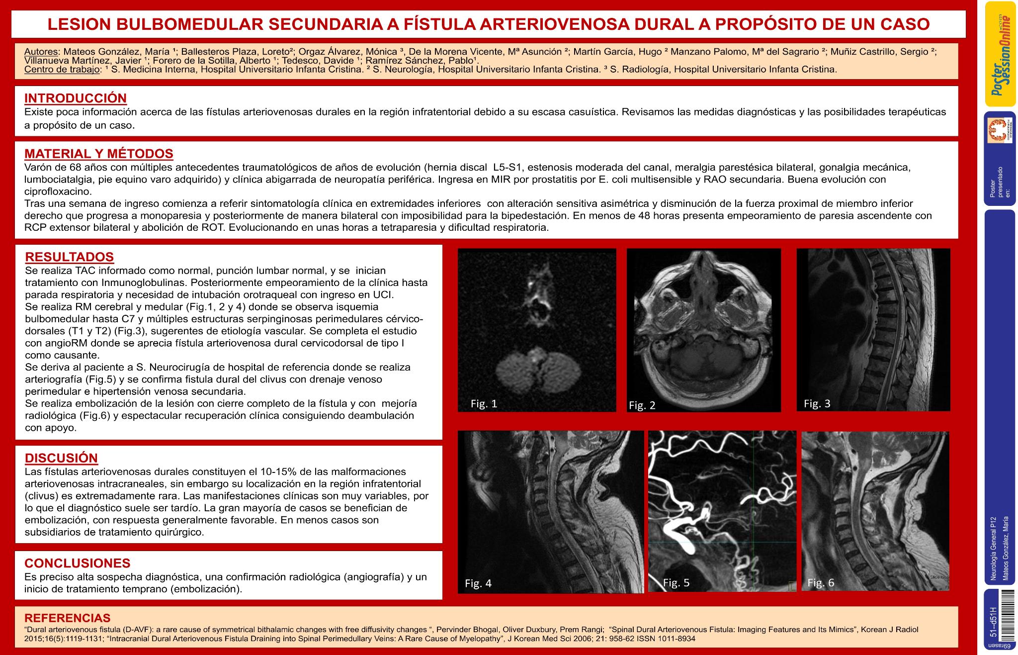 Lesión bulbomedular secundaria a fístula arteriovenosa dural a propósito de un caso