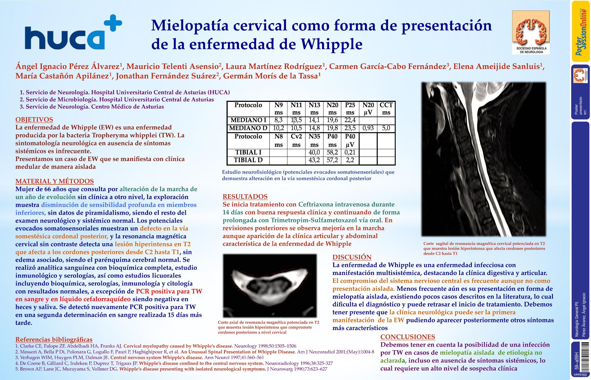 Mielopatía cervical como forma de presentación de la enfermedad de Whipple