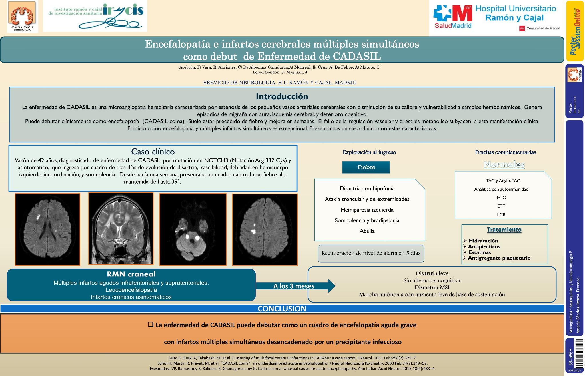 Encefalopatía e infartos cerebrales múltiples simultáneos como debut de enfermedad de CADASIL
