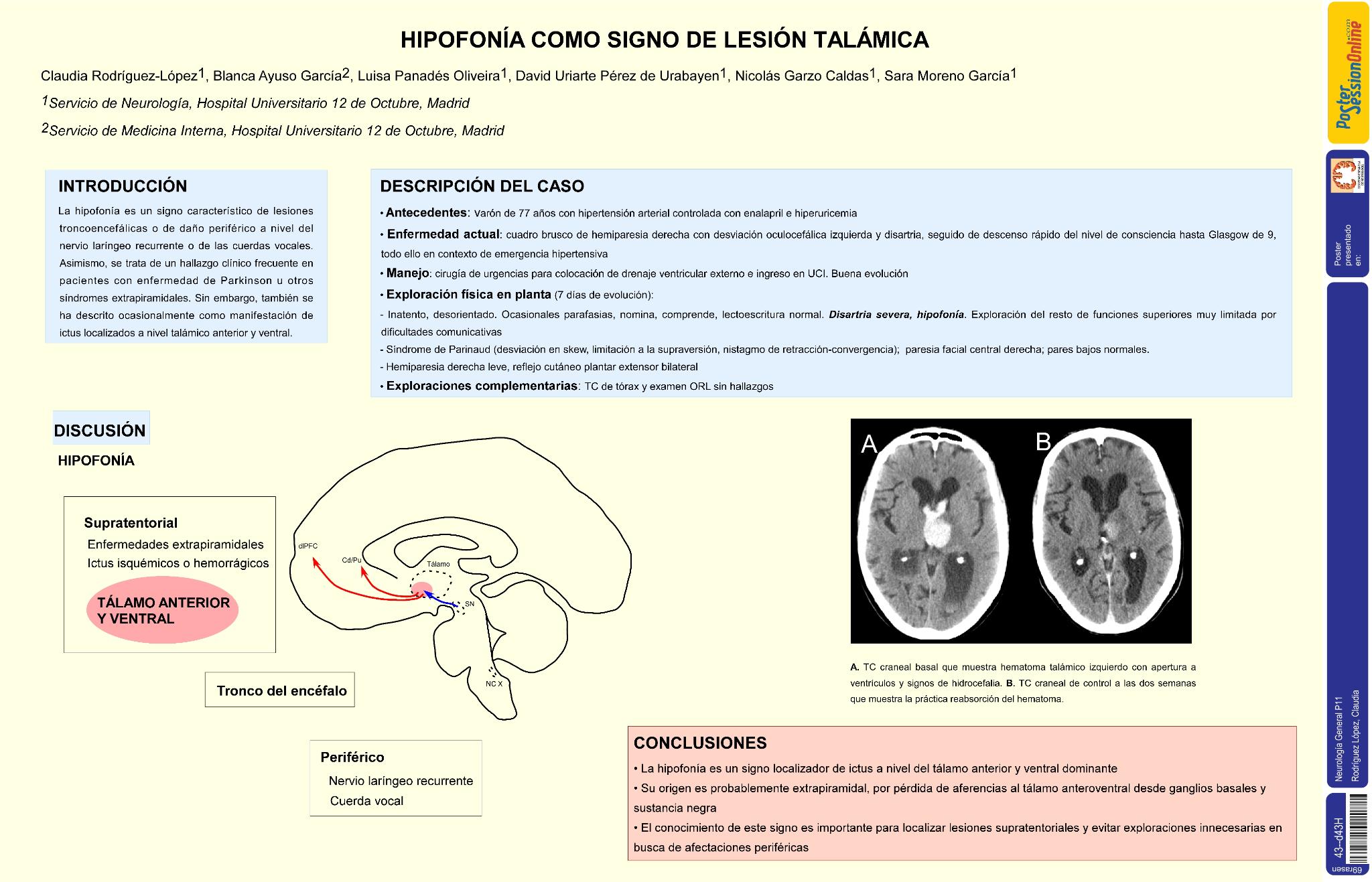 Hipofonía como signo de lesión talámica