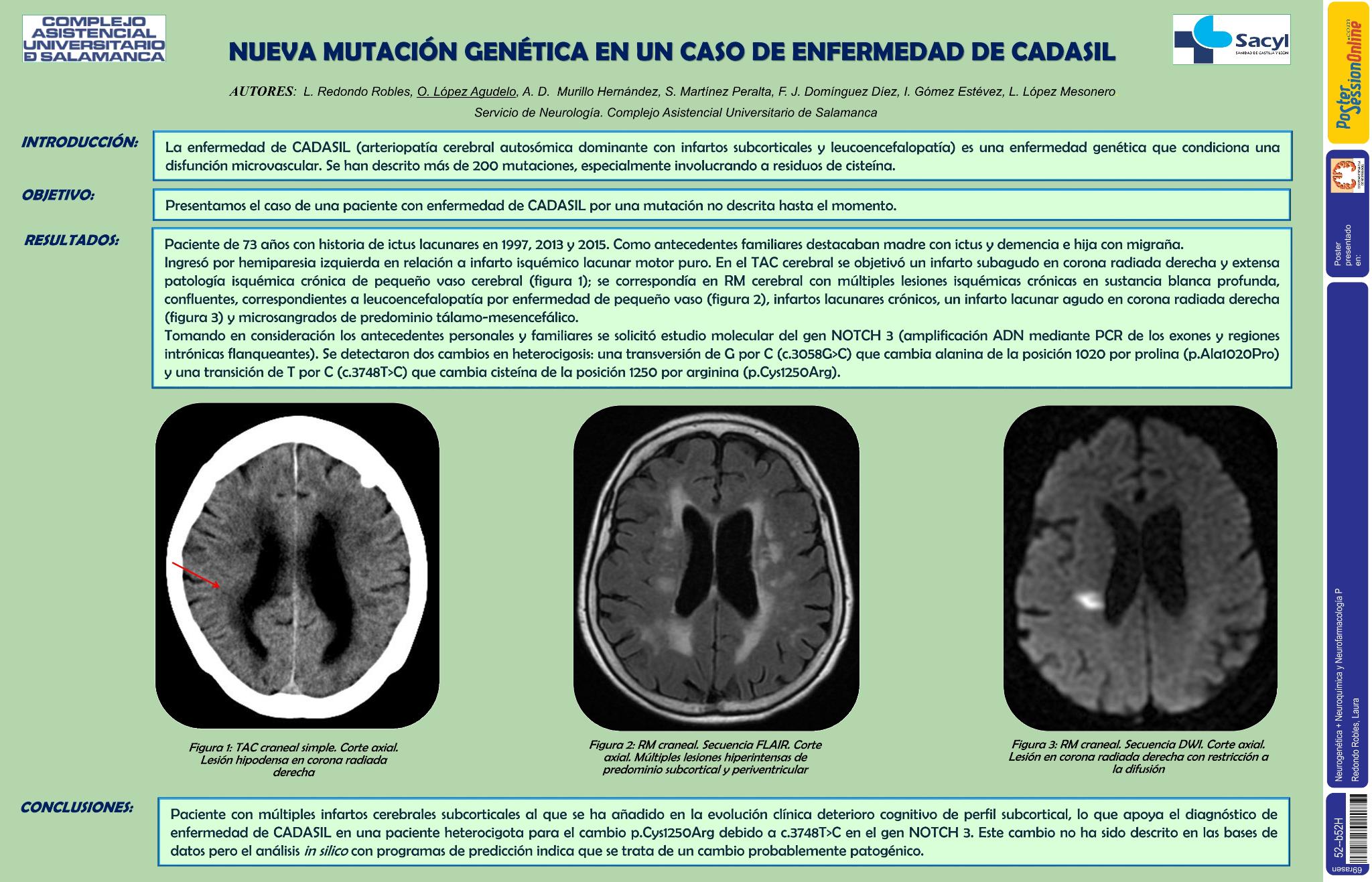 Nueva mutación genética en un caso de enfermedad de CADASIL