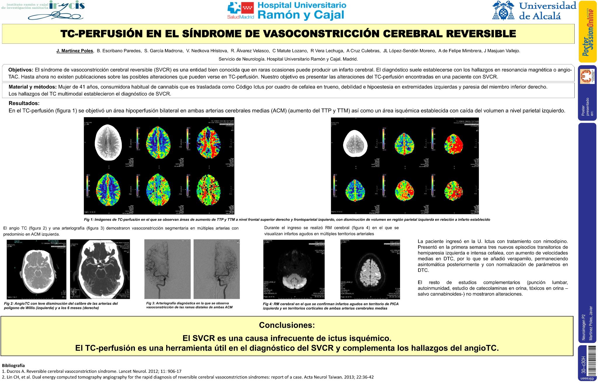 TC-perfusión en el síndrome de vasoconstricción reversible