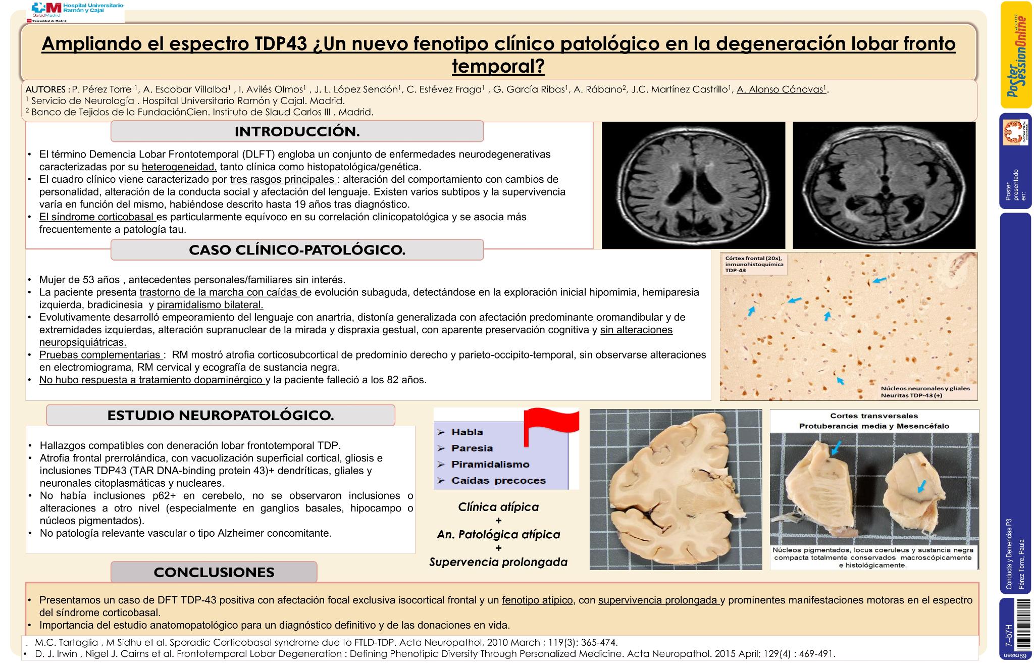 Ampliando el espectro TDP-43: ¿un nuevo fenotipo clínico-patológico en la degeneración lobular fronto temporal?