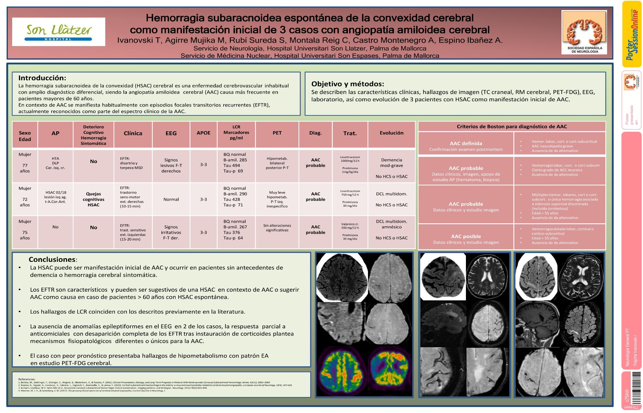 Hemorragia subaracnoidea de la convexidad cerebral espontánea como manifestación inicial de 3 casos con angiopatía amiloidea cerebral