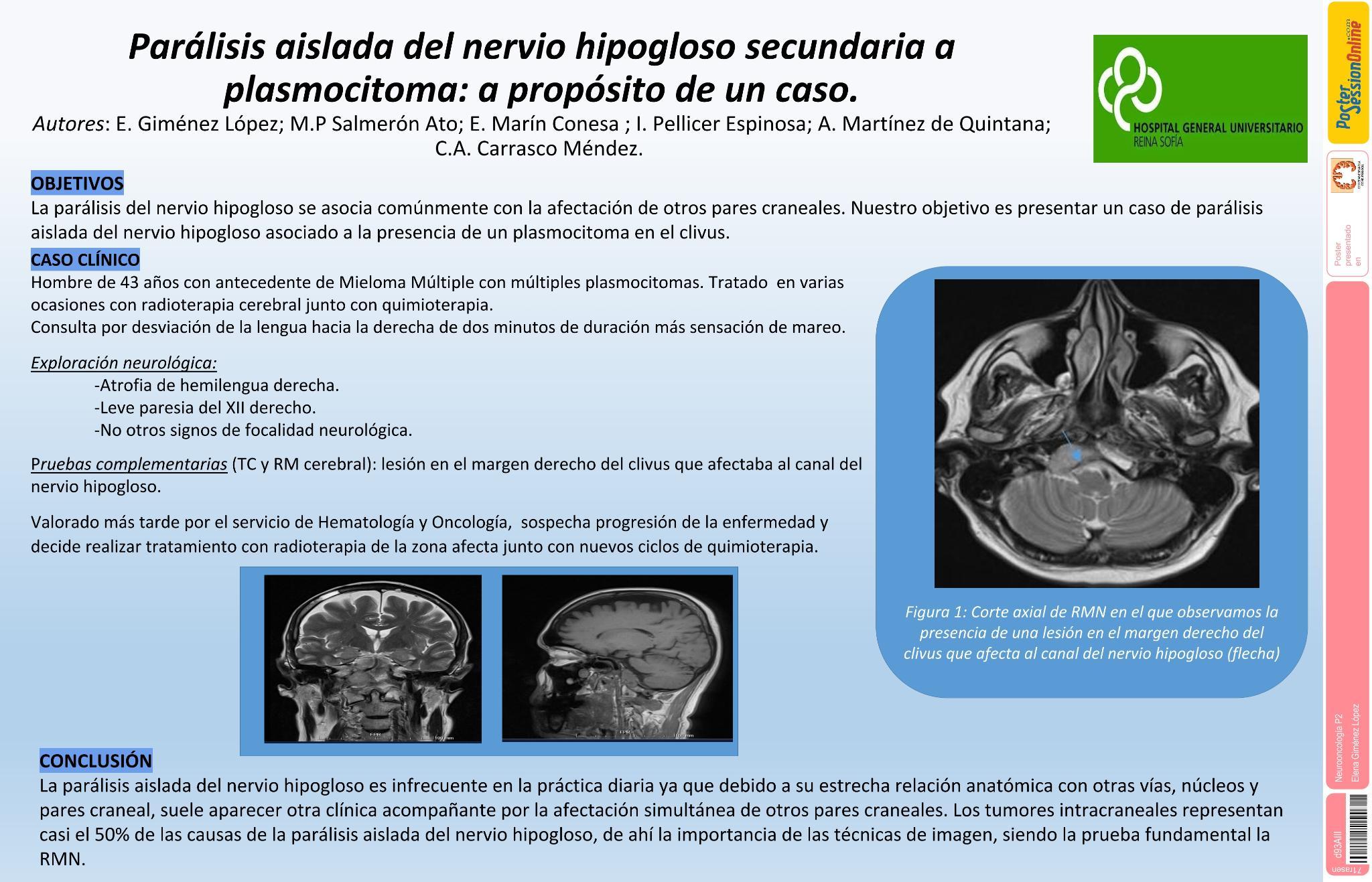 Parálisis aislada del nervio hipogloso secundaria a plasmocitoma: a propósito de un caso